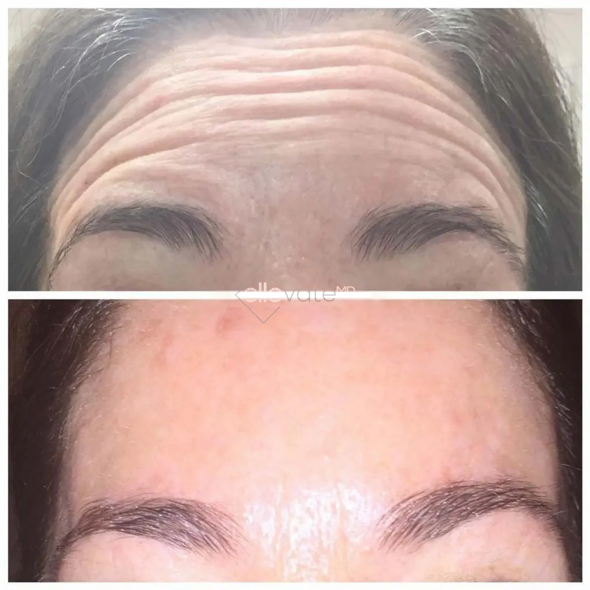 Botox before and after