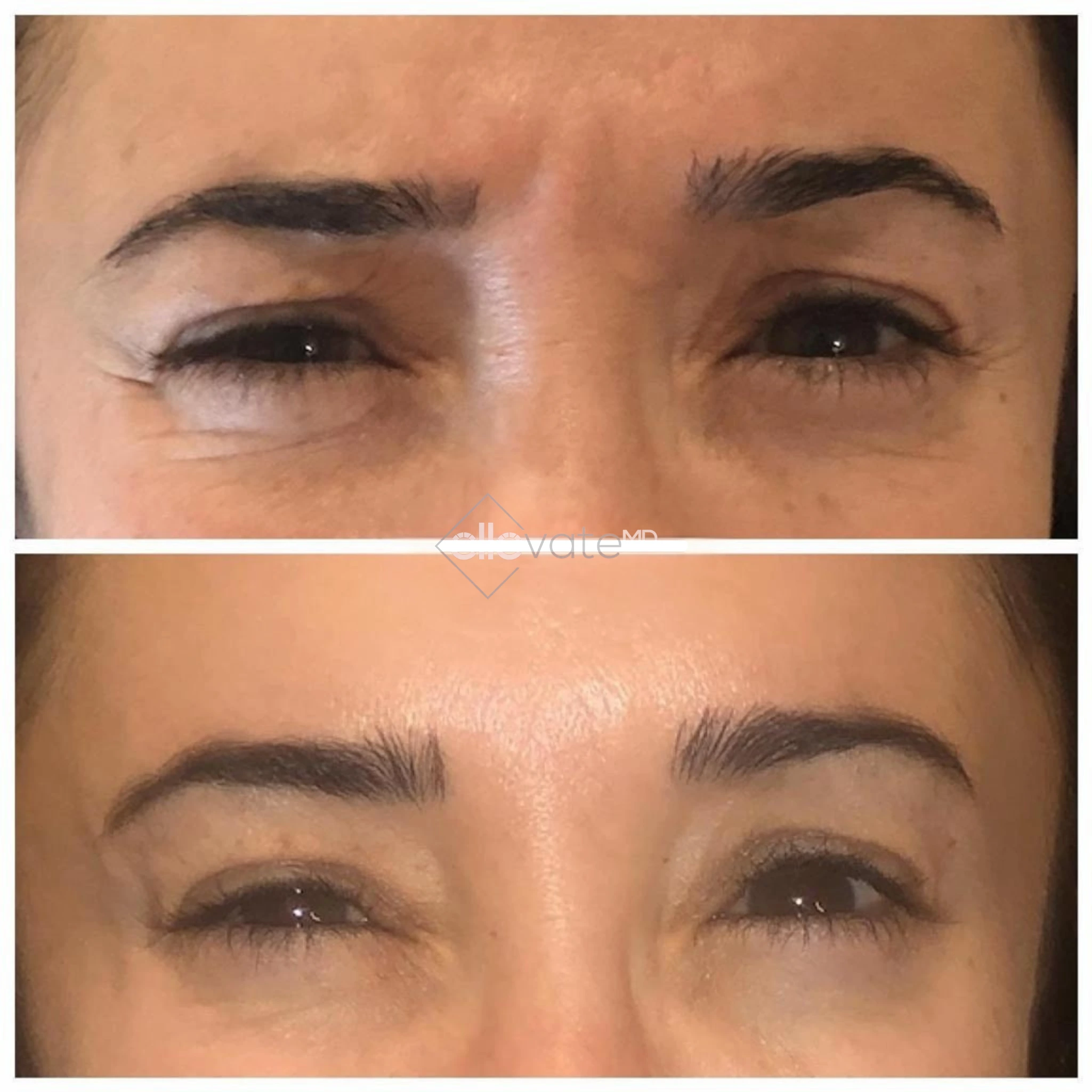 Botox before and after