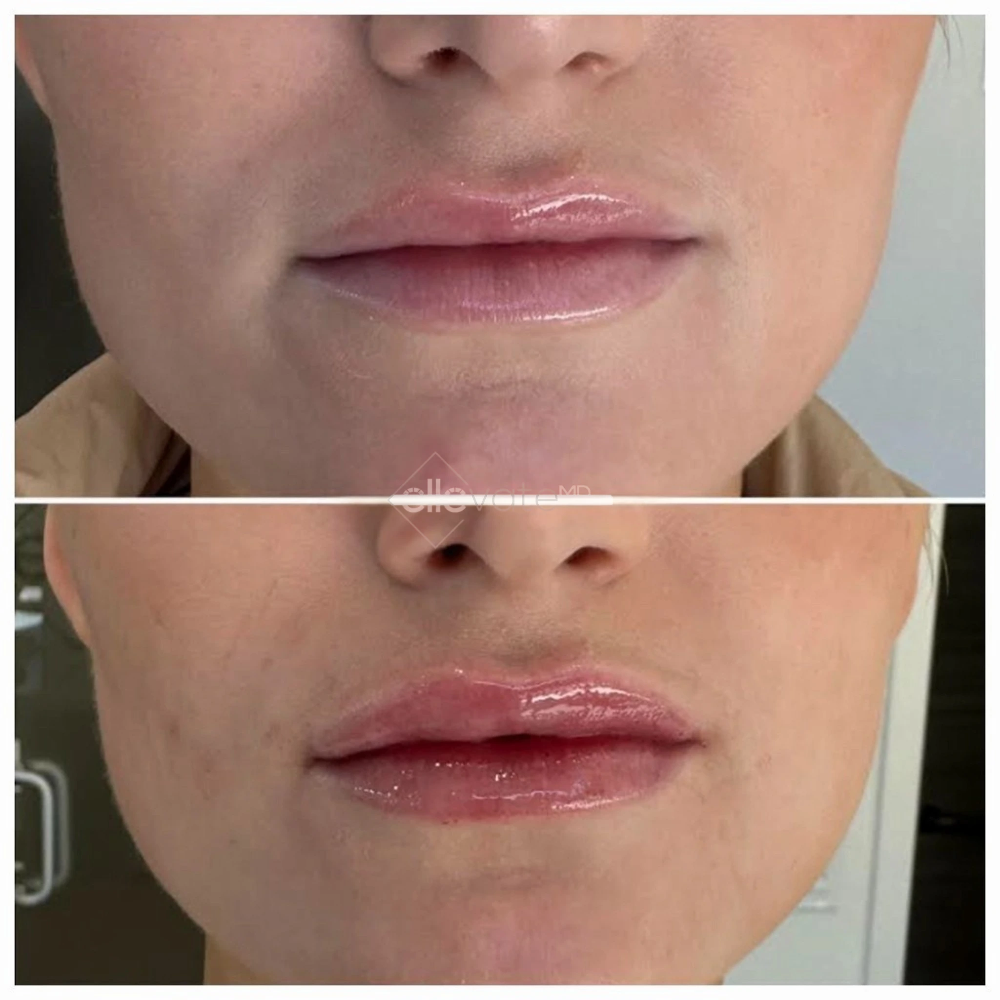 Fillers before and after