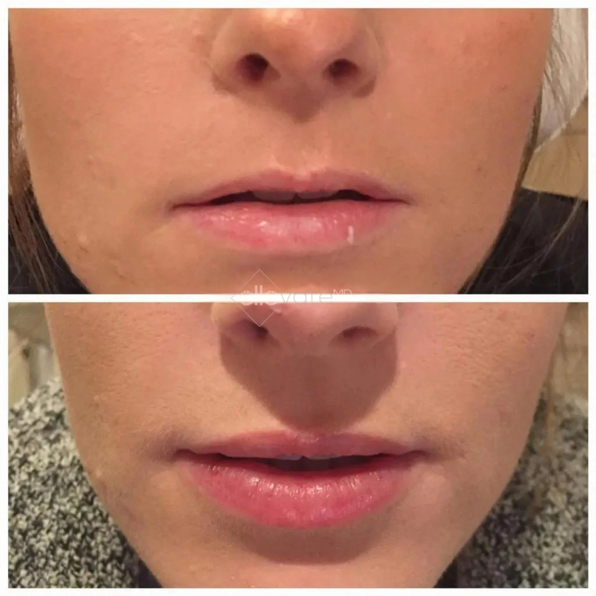 Fillers before and after