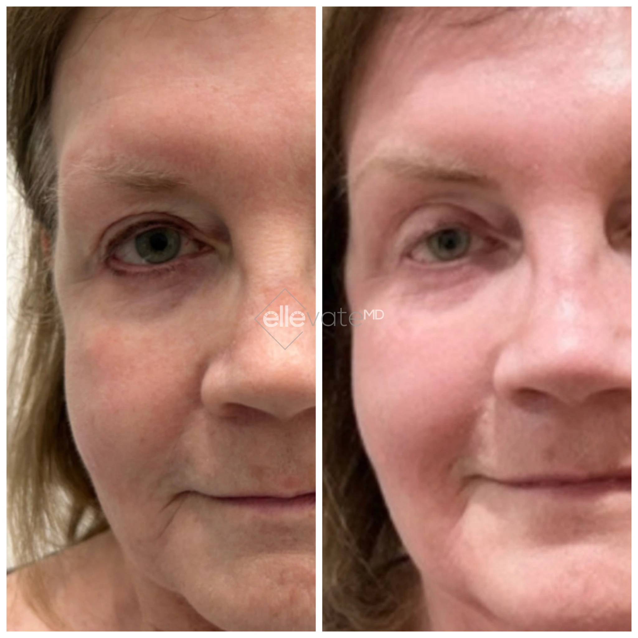 Fraxel laser before and after