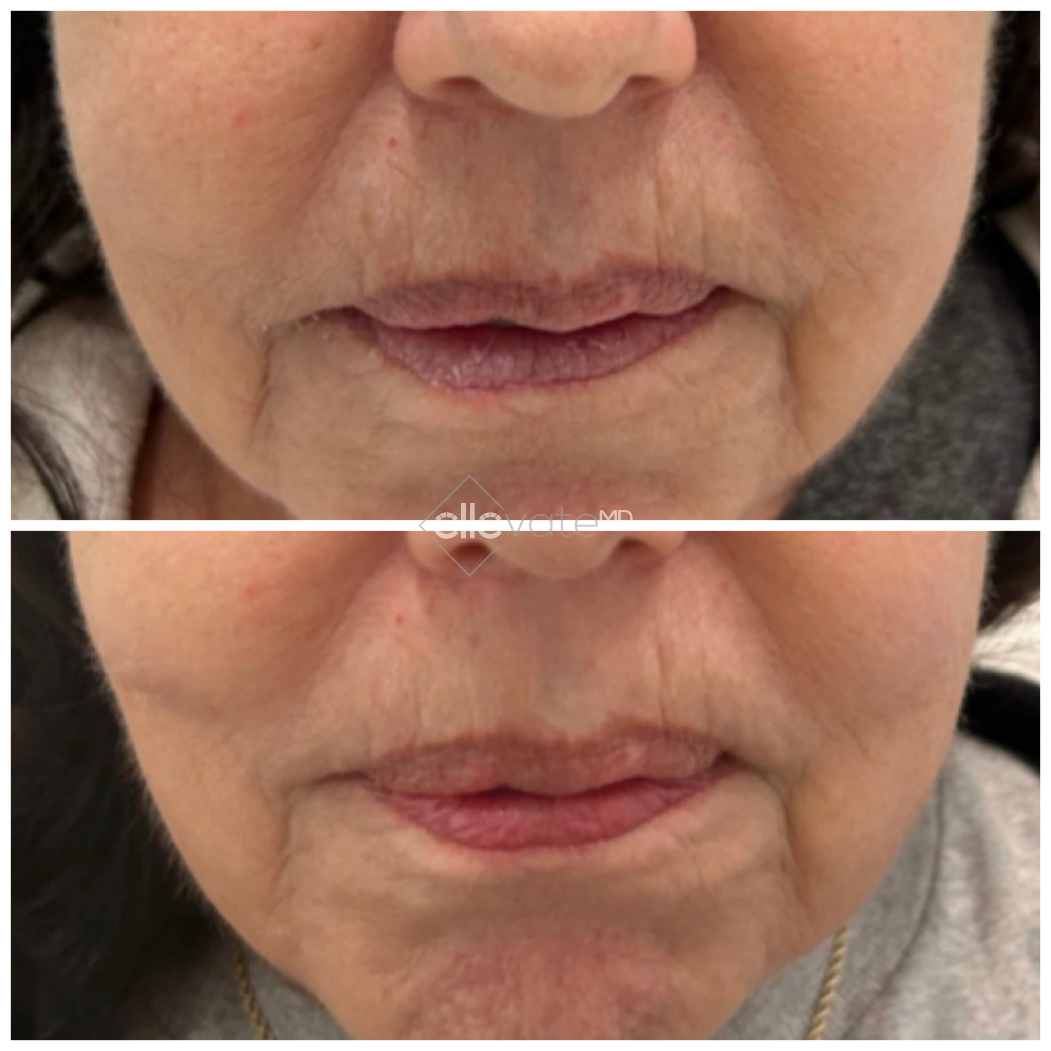 Fraxel laser before and after