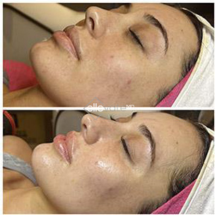 JetPeel Pro before and after