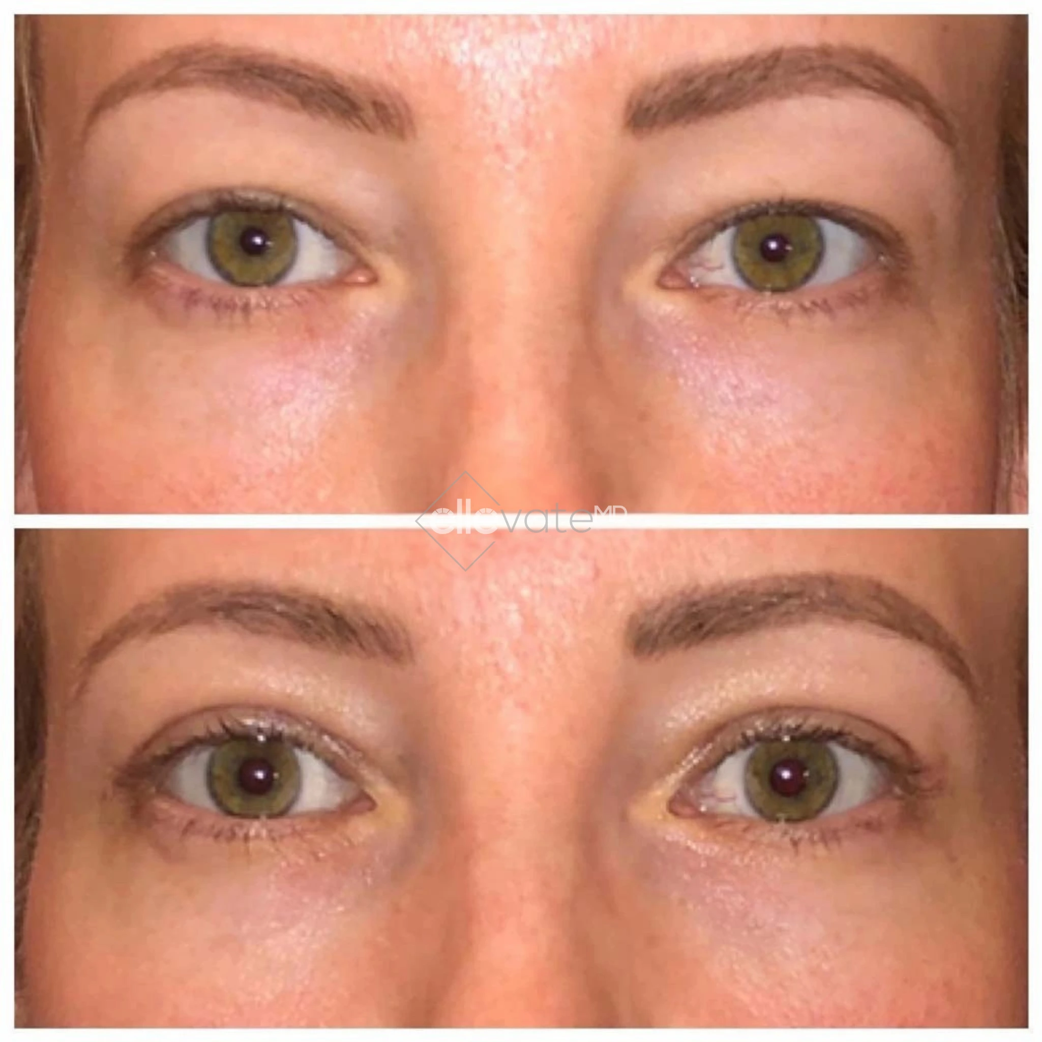Signature Lid Lift before and after