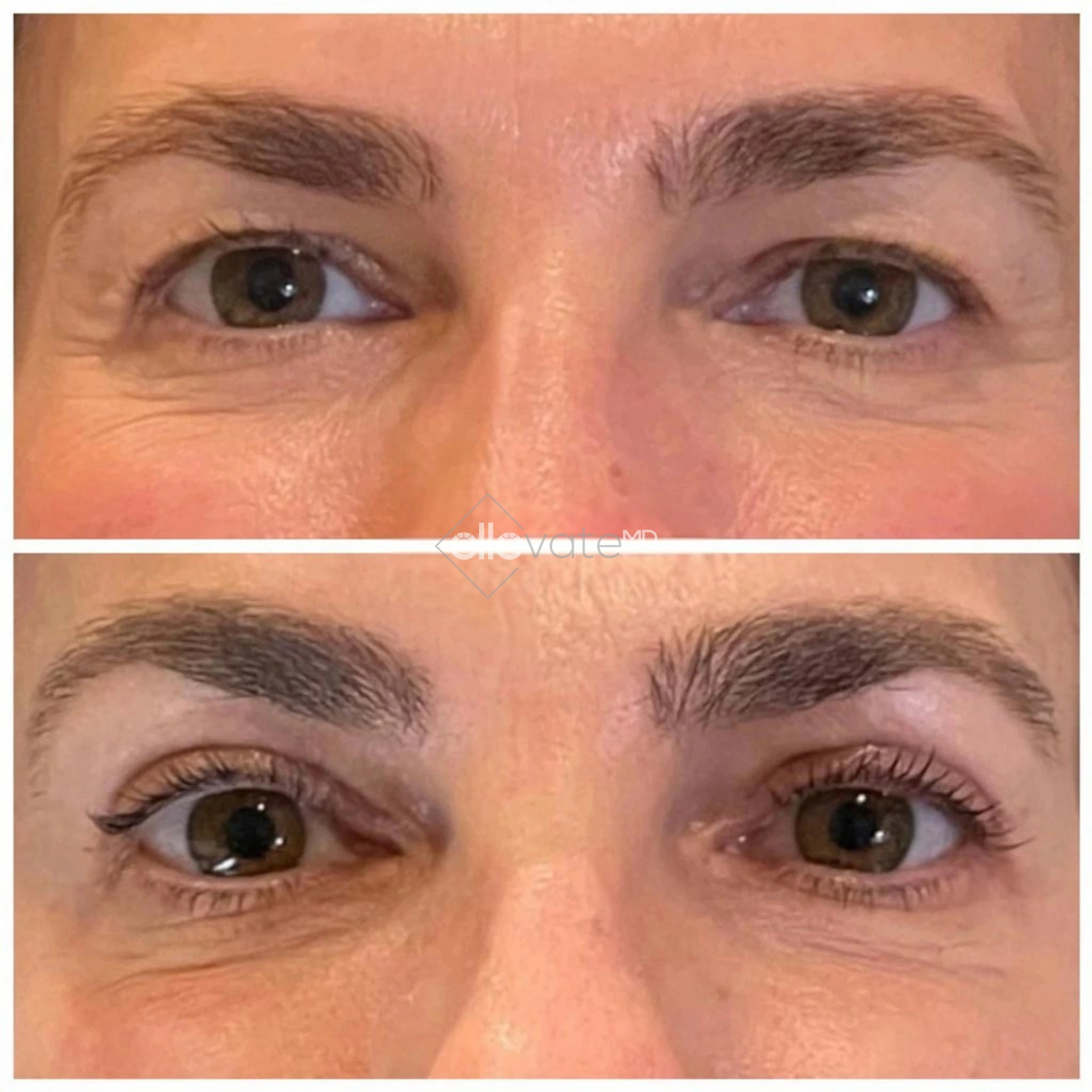 Signature Lid Lift before and after