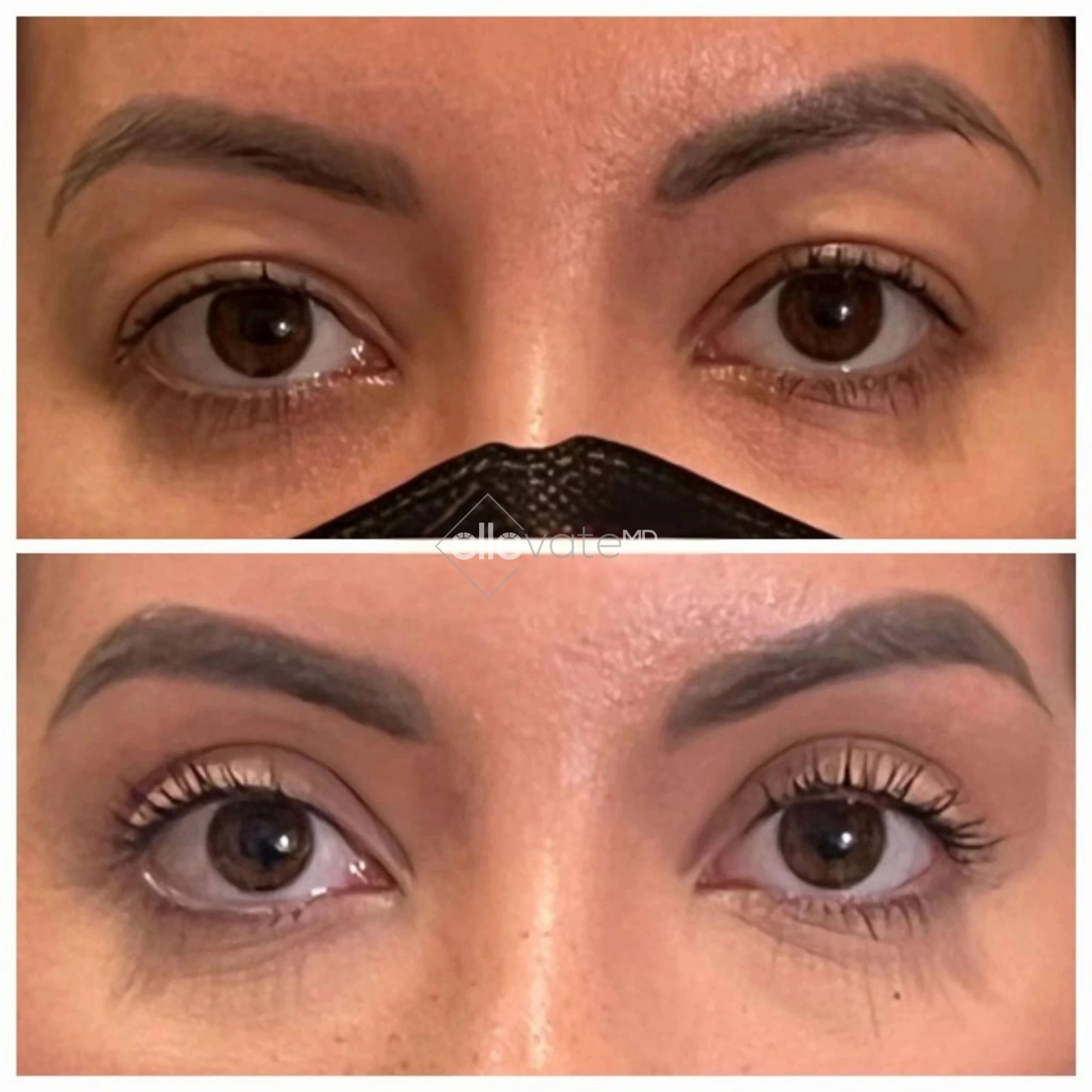 Signature Lid Lift before and after