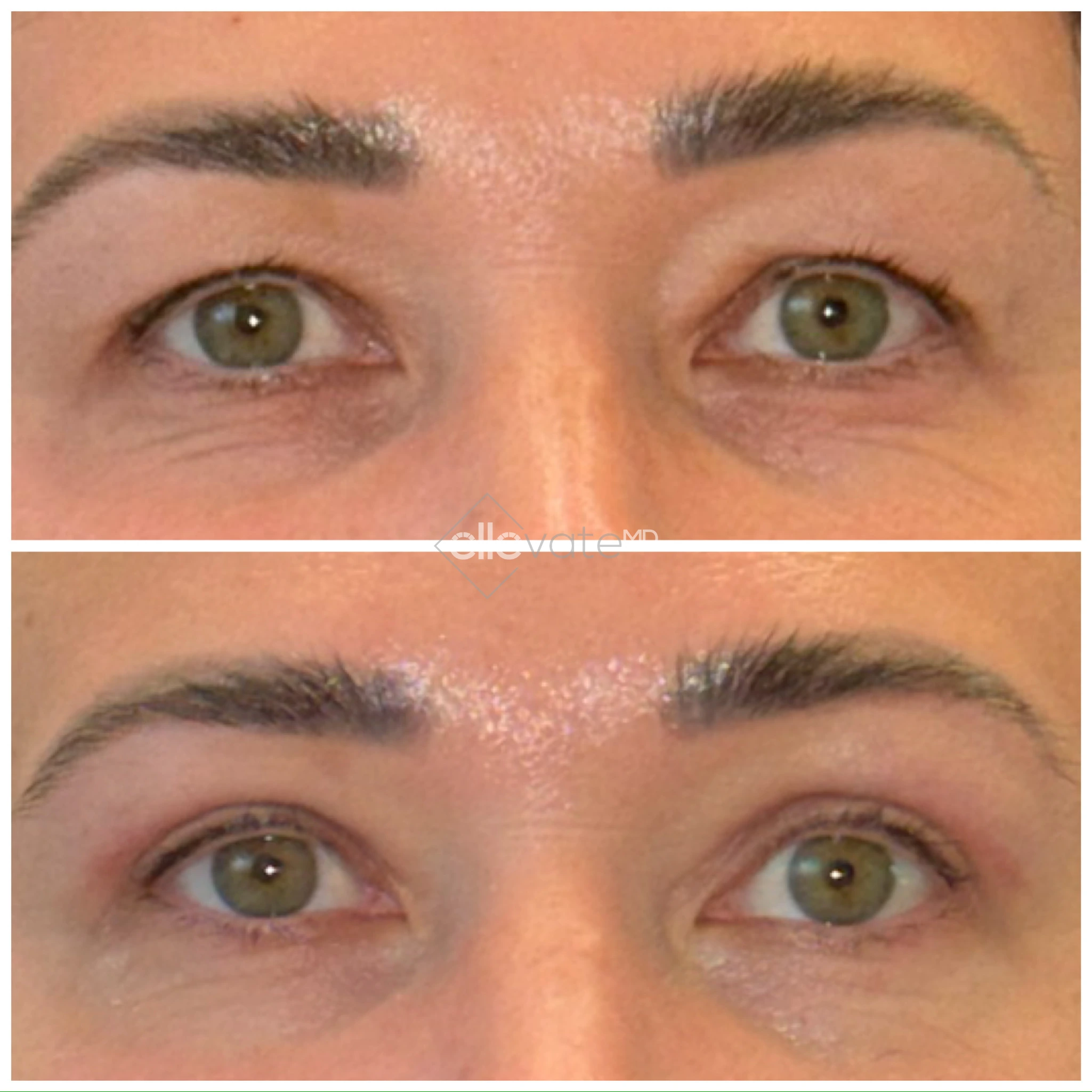 Signature Lid Lift before and after