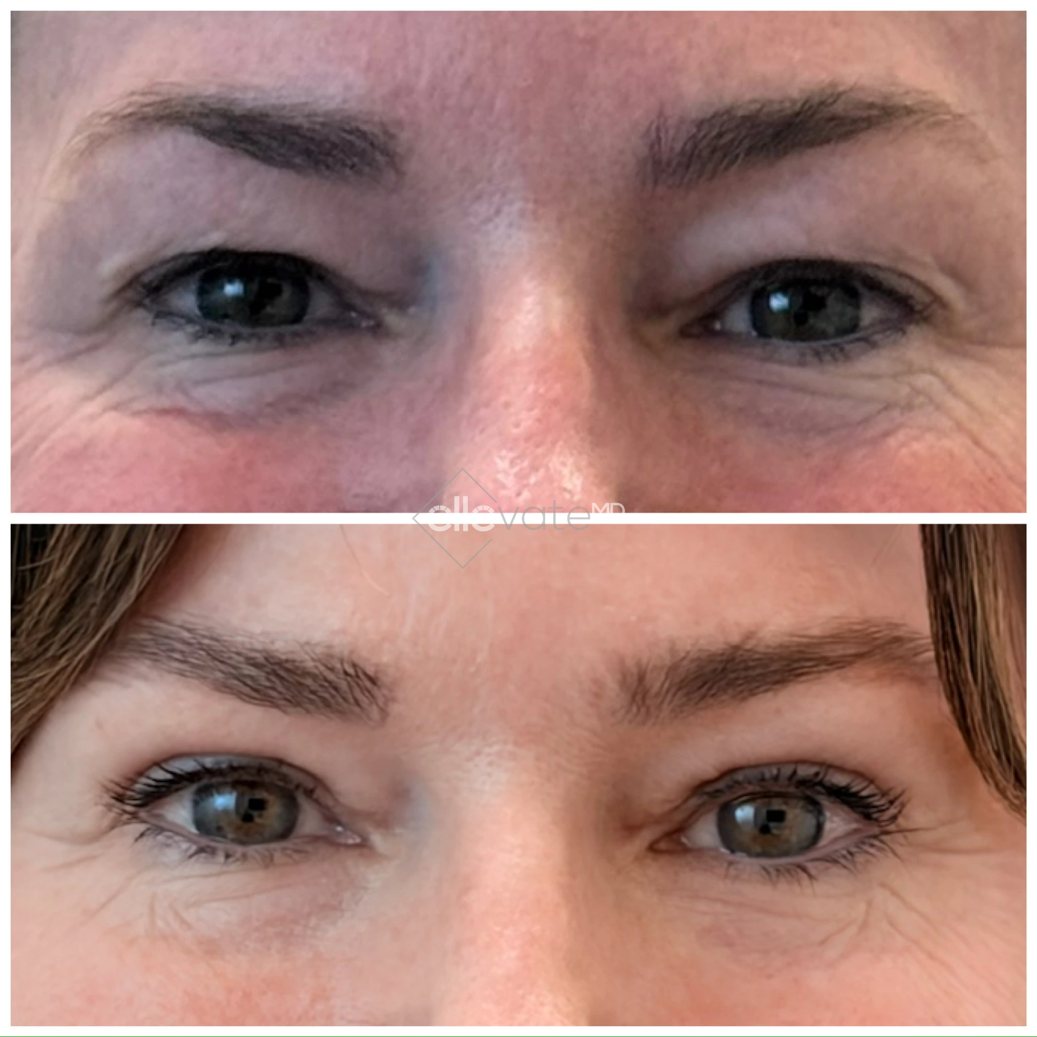 Signature Lid Lift before and after