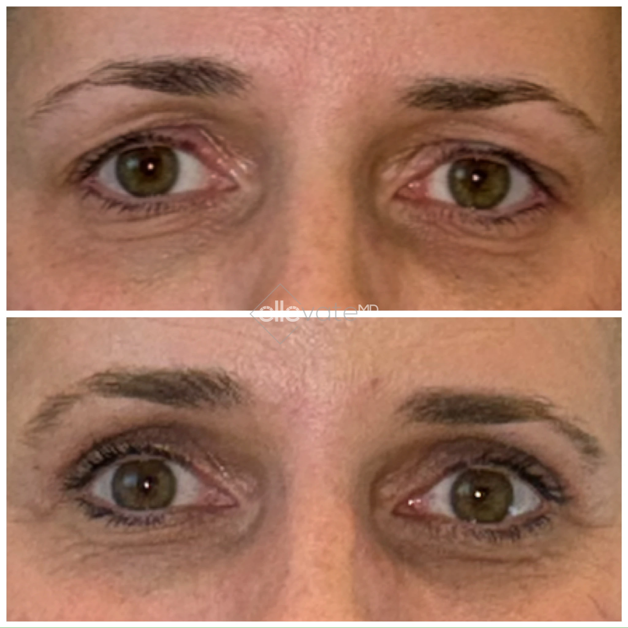 Signature Lid Lift before and after