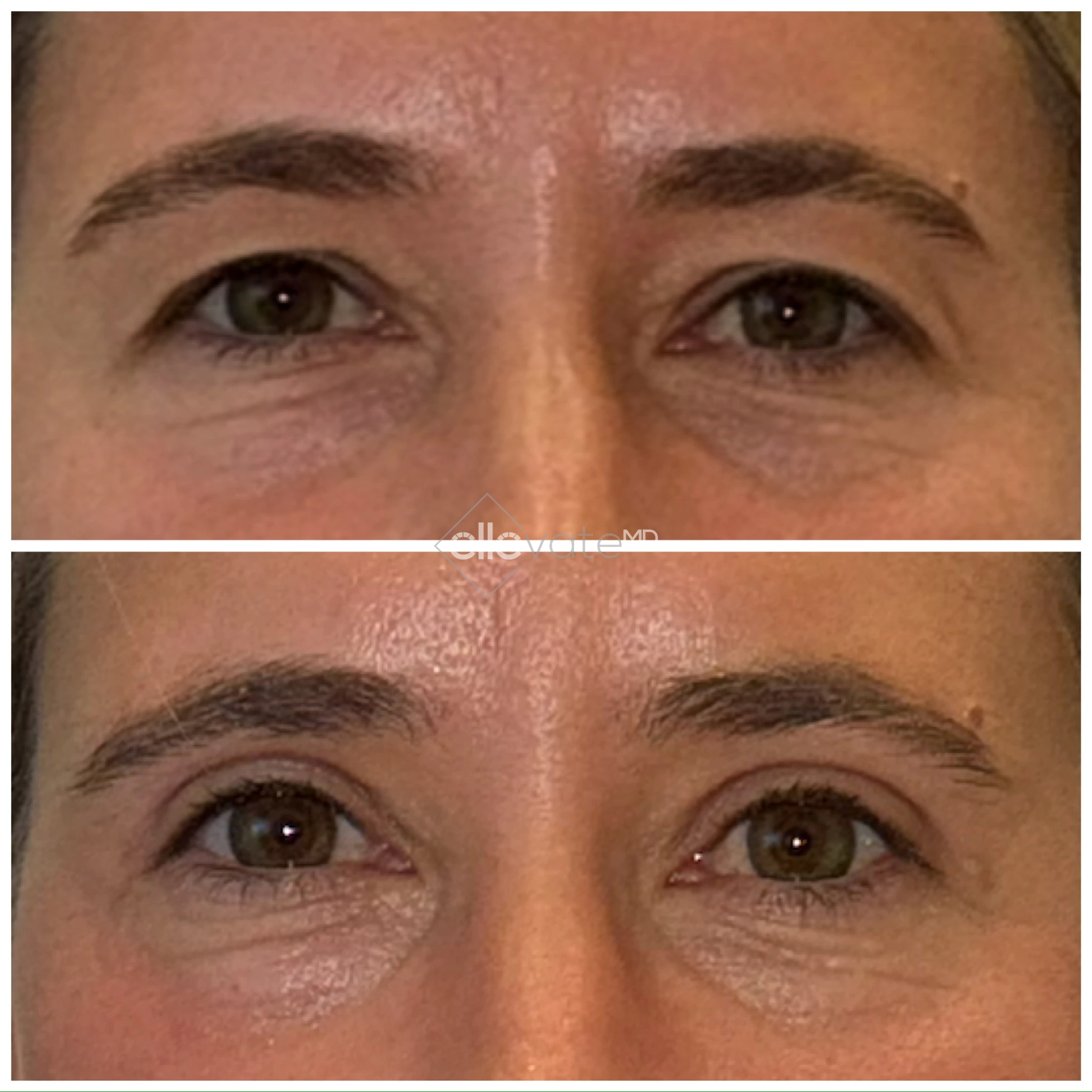 Signature Lid Lift before and after