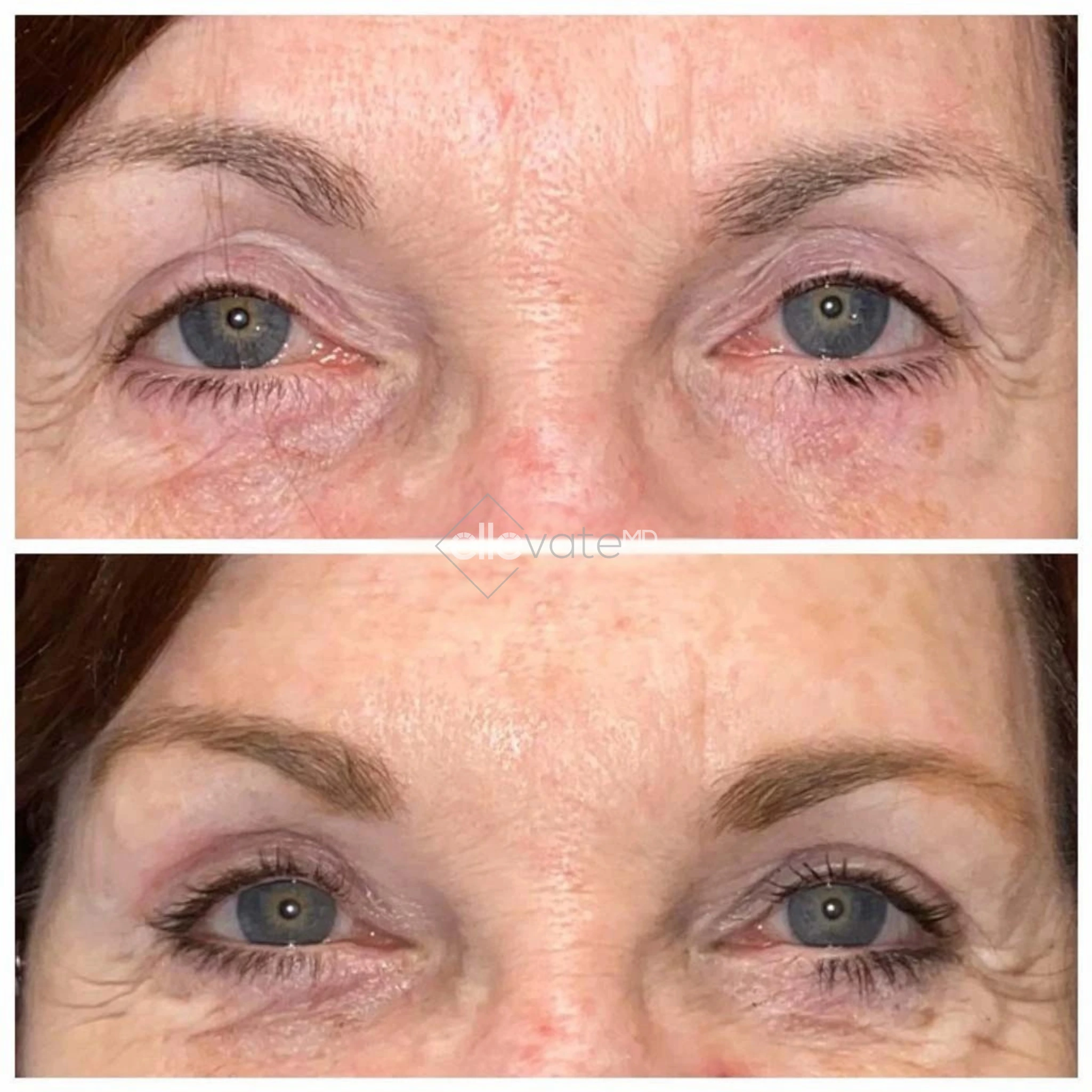 Lower blepharoplasty before and after