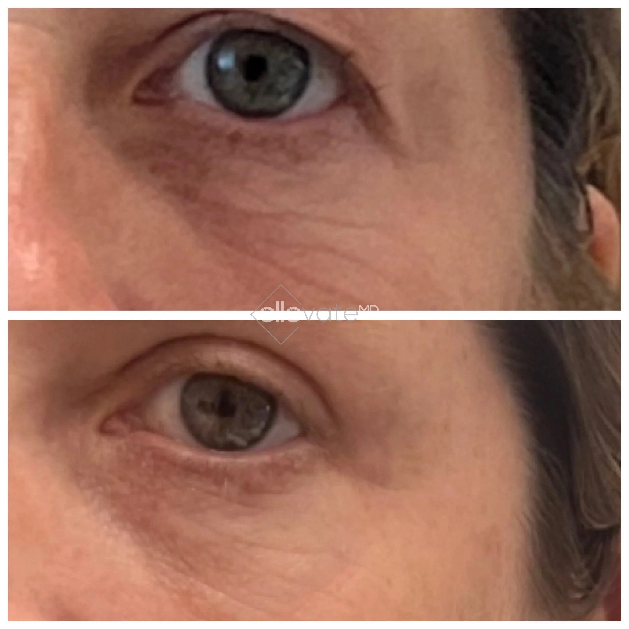 RF microneedling before and after