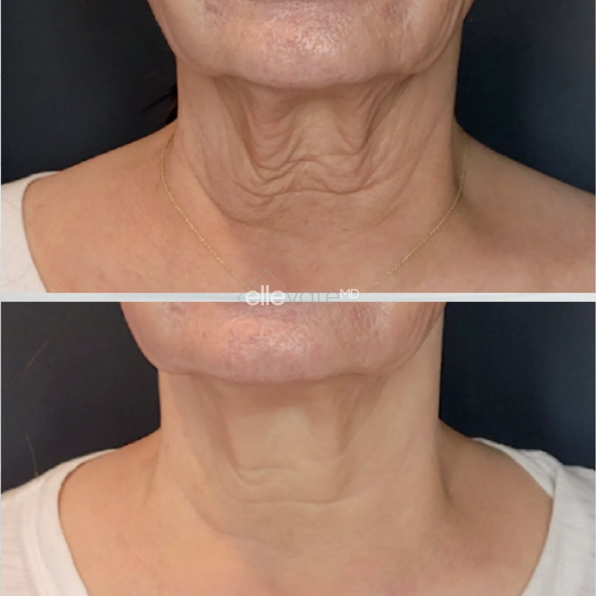 Sofwave before and after