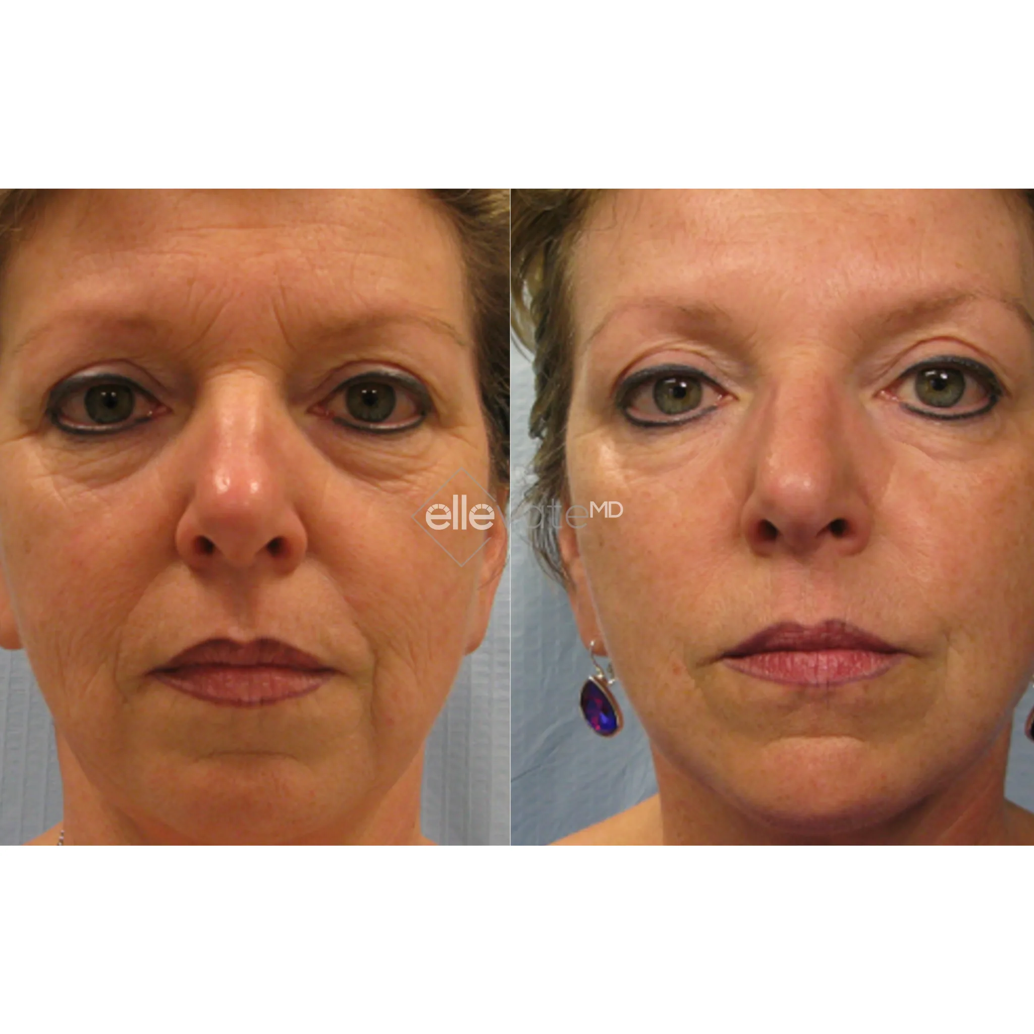 Tixel before and after