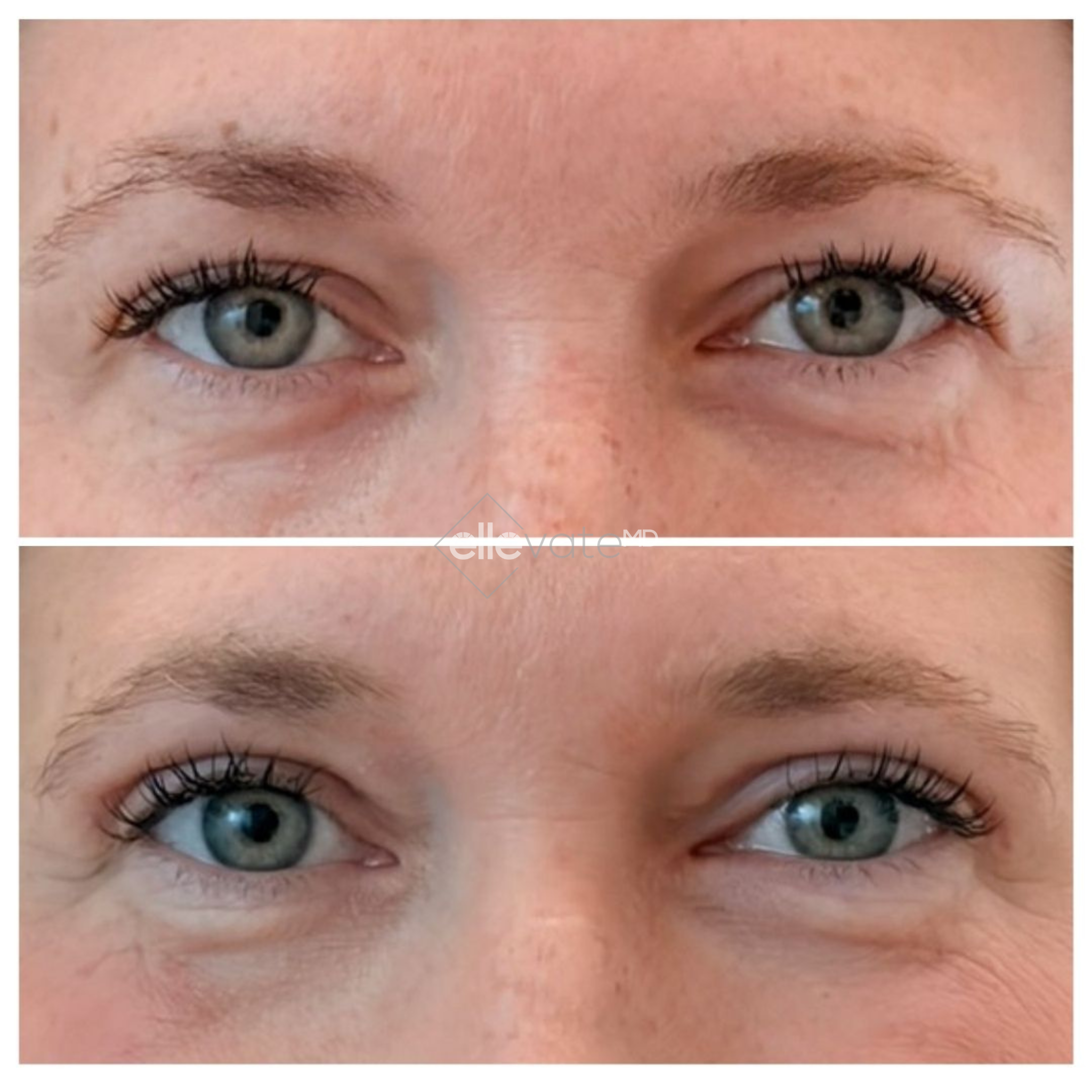 Before and after Signature Lift 217 treatment showing reduced under-eye hollowness and improved skin texture around eyes