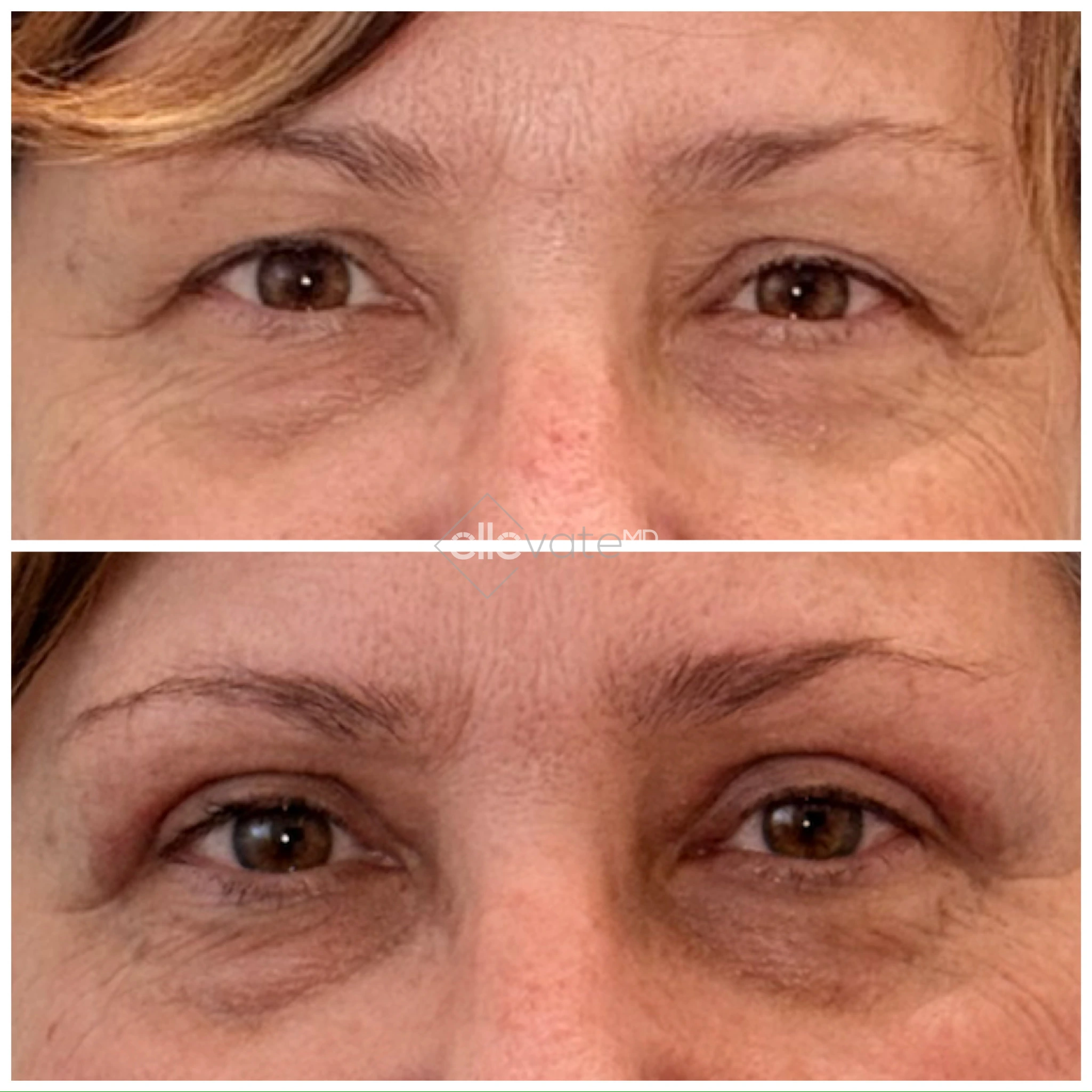 Before and after Signature Lift showing improved eye opening and reduced forehead heaviness
