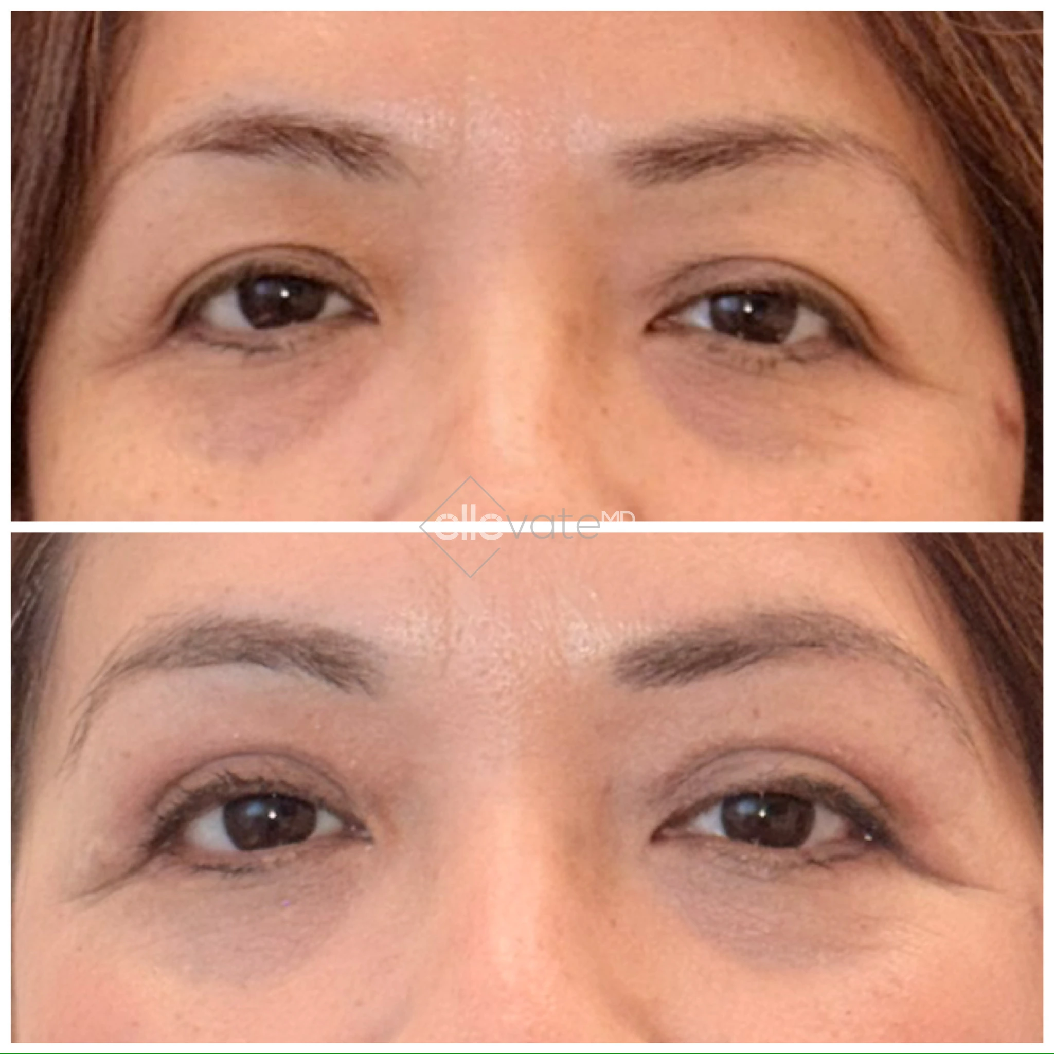 Before and after comparison of eye area showing reduced under-eye bags and improved skin texture