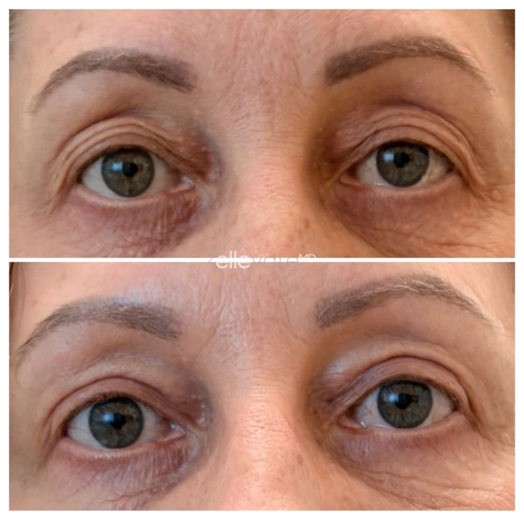 Before and after front view of patient's eyes showing improved eye appearance from Signature Lift