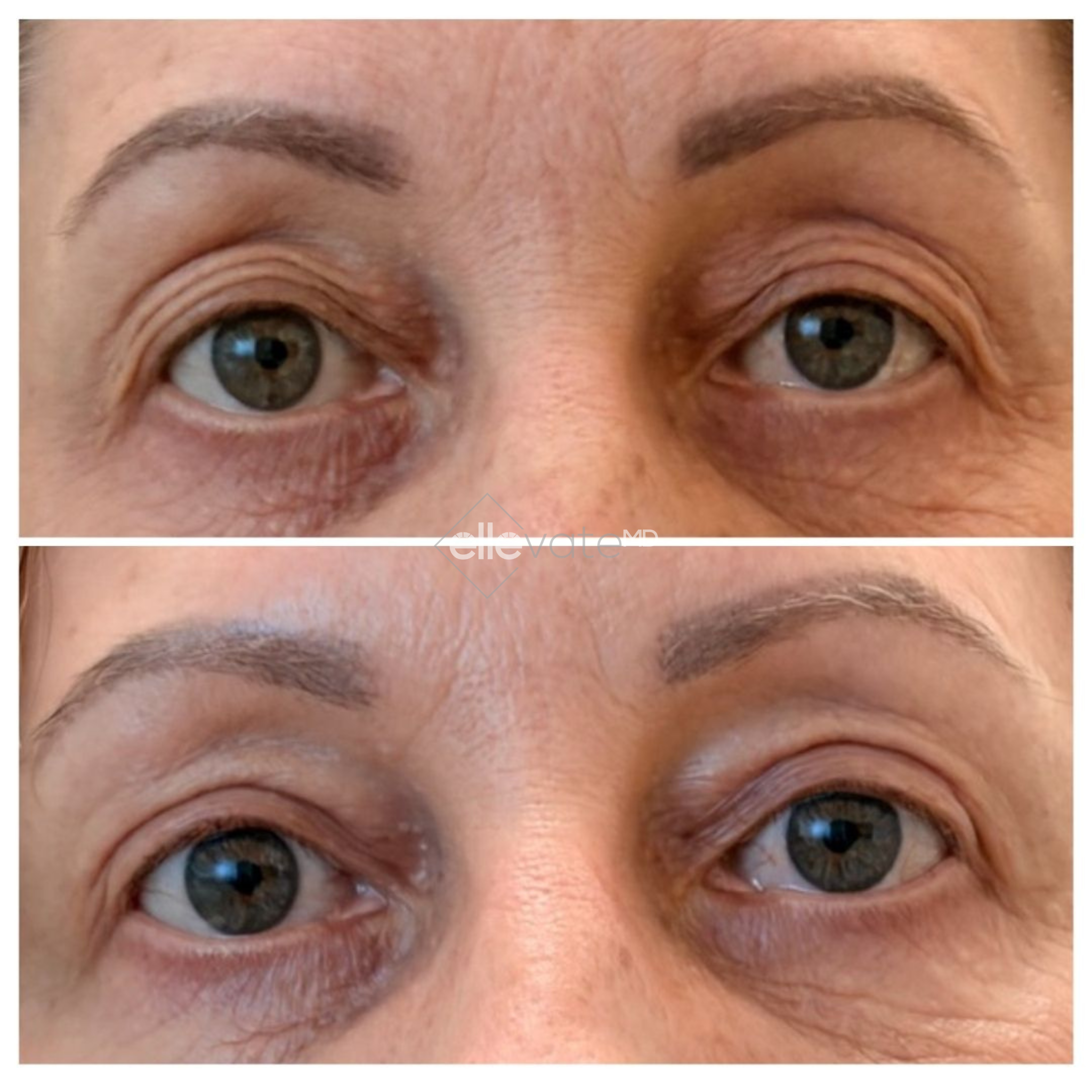 Before and after front view of patient's eyes showing improved eye appearance from Signature Lift