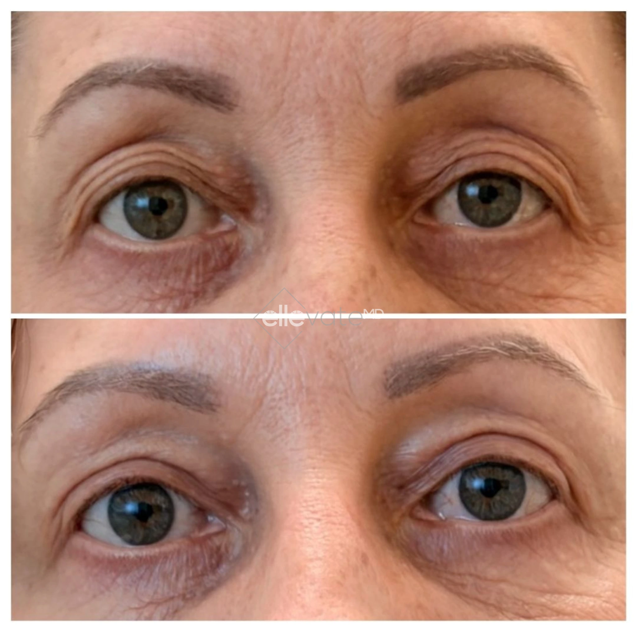 Before and after front view of patient's eyes showing improved eye appearance from Signature Lift