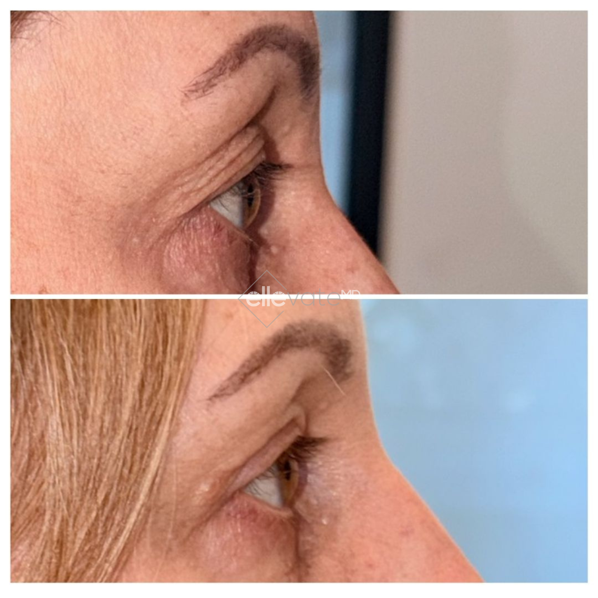 Before and after profile view of patient's neck and jawline showing Signature Lift results