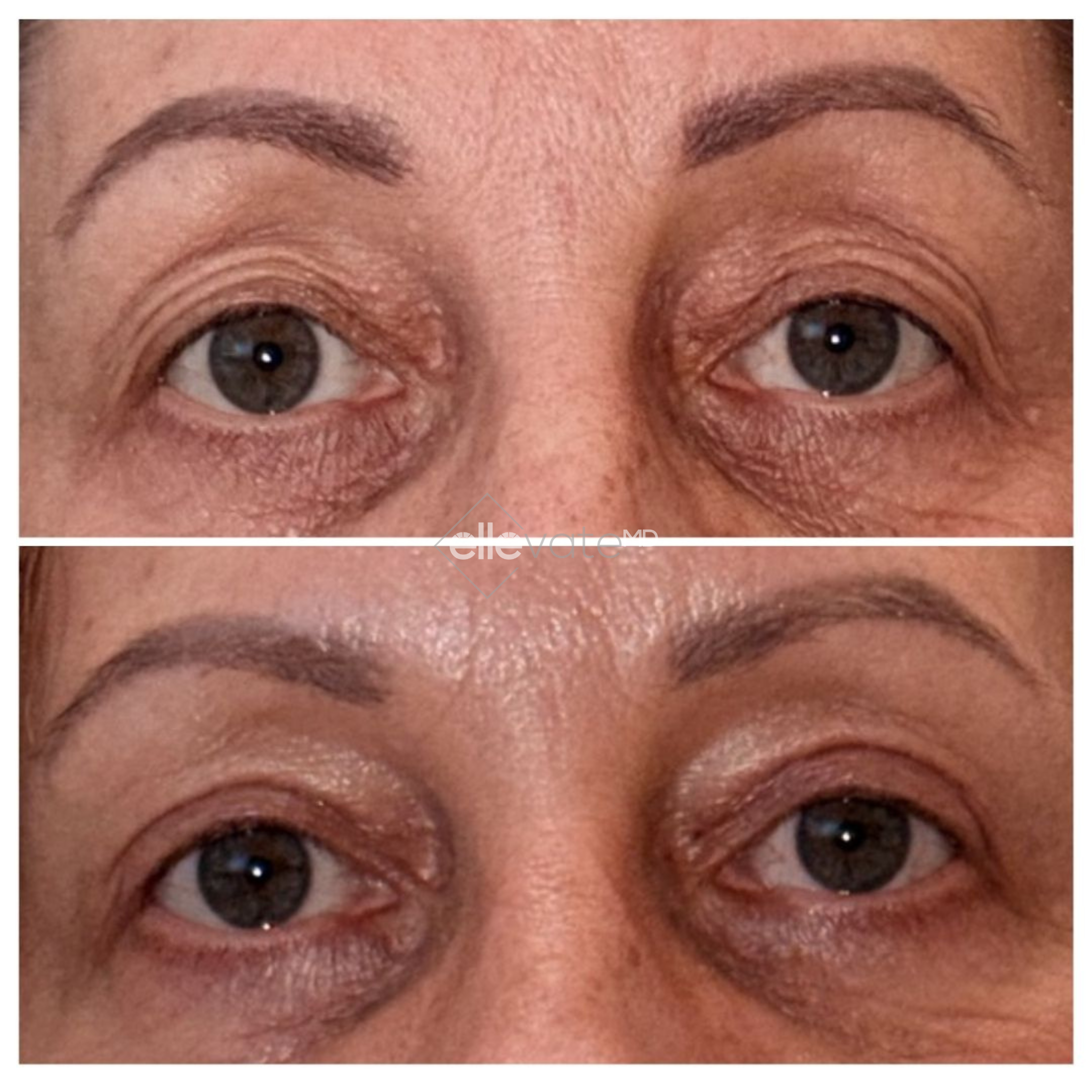 Before and after front view of patient's eyes showing smoother skin texture from Signature Lift