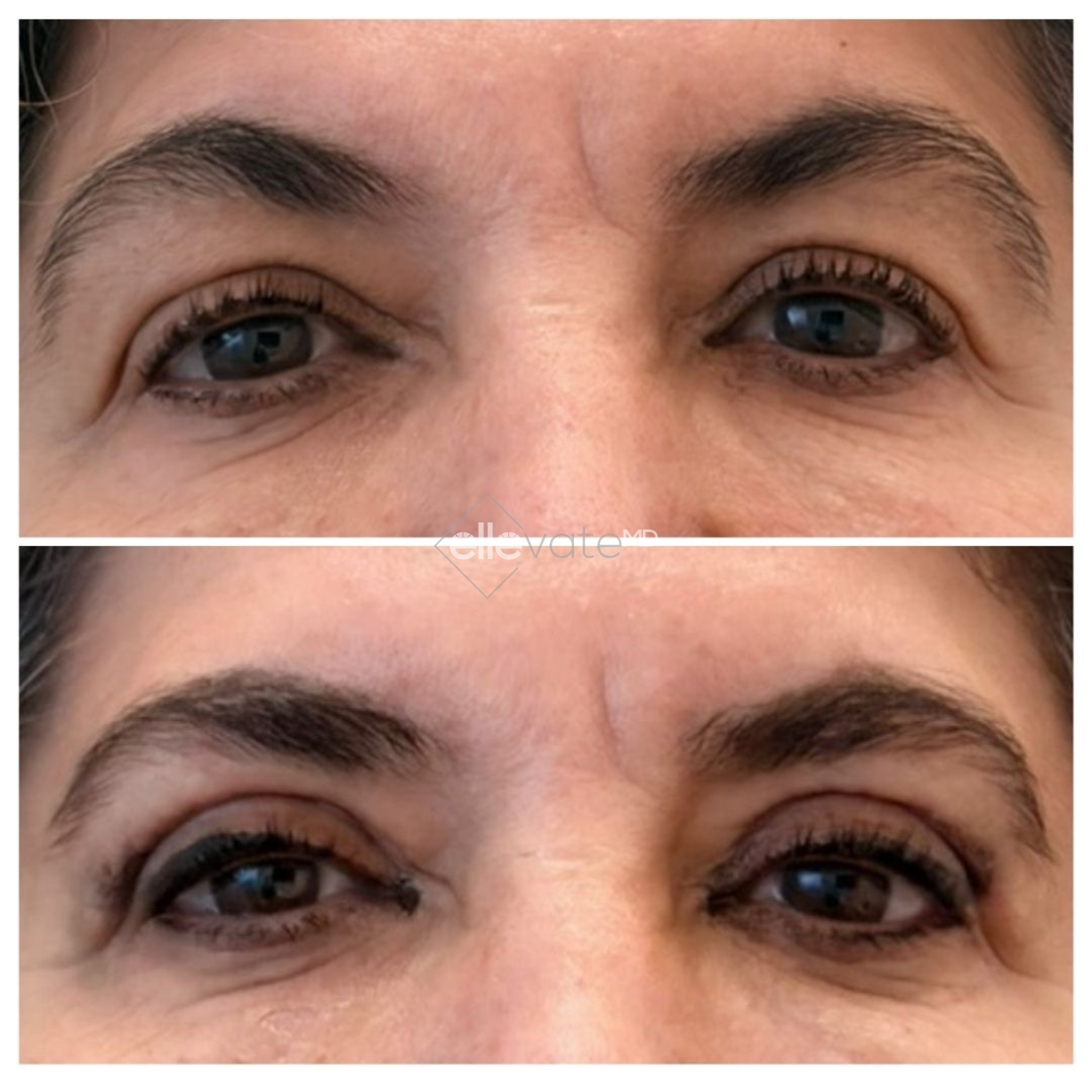Before and after comparison of eyes showing reduced wrinkles and lifted appearance