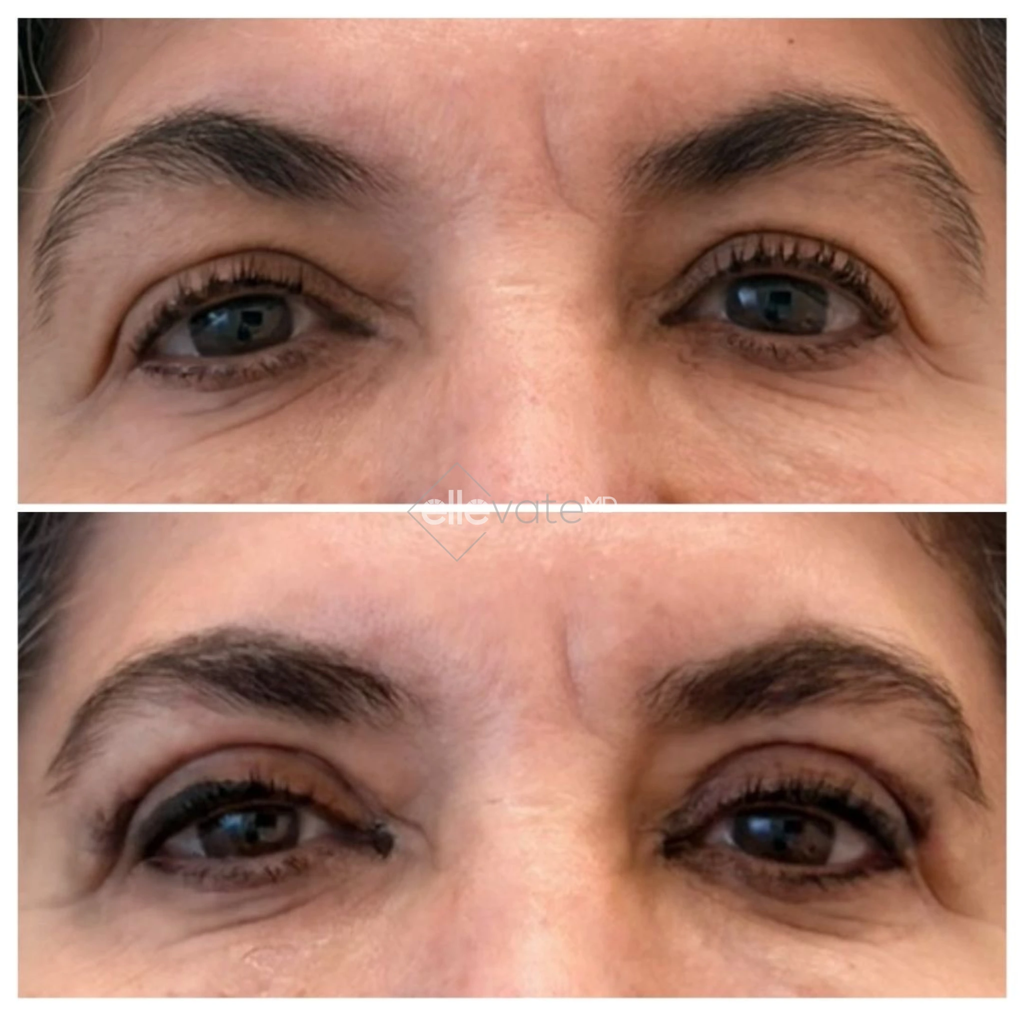 Before and after comparison of eyes showing reduced wrinkles and lifted appearance