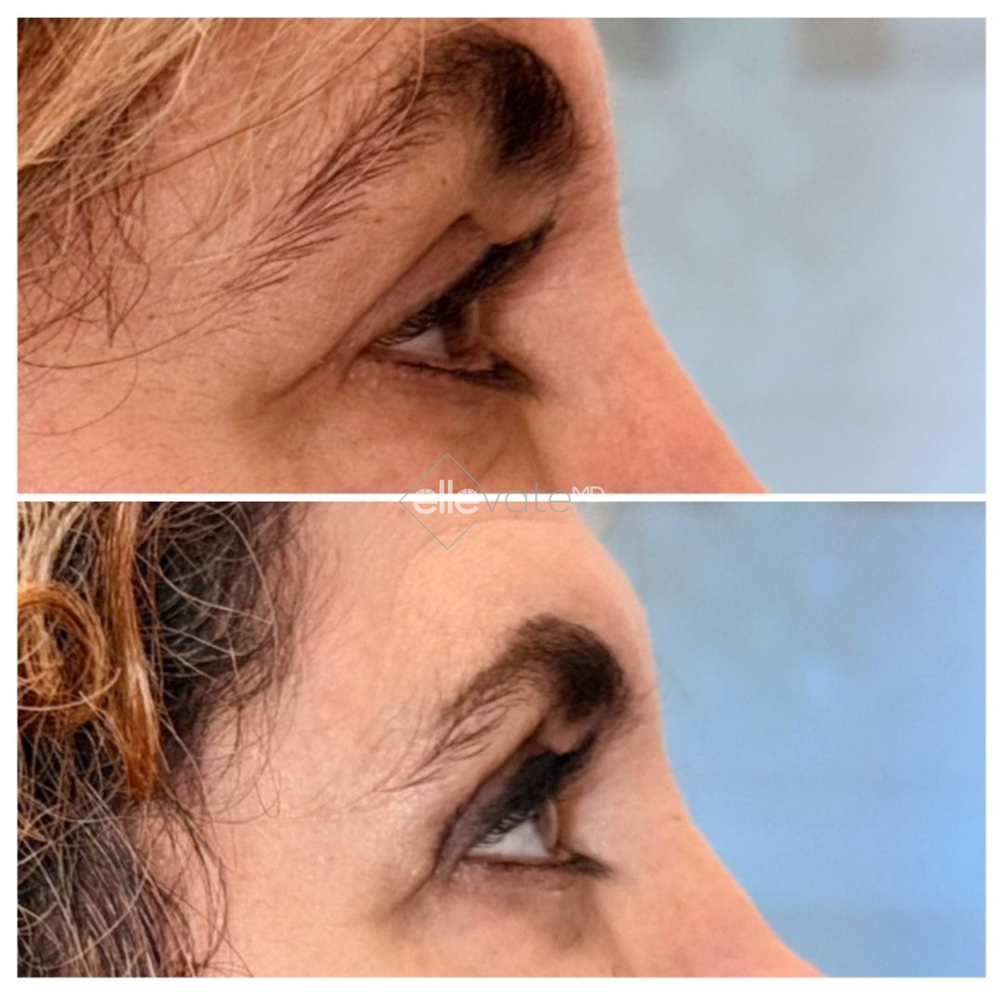 Before and after profile view of patient's mouth and chin area showing Signature Lift results