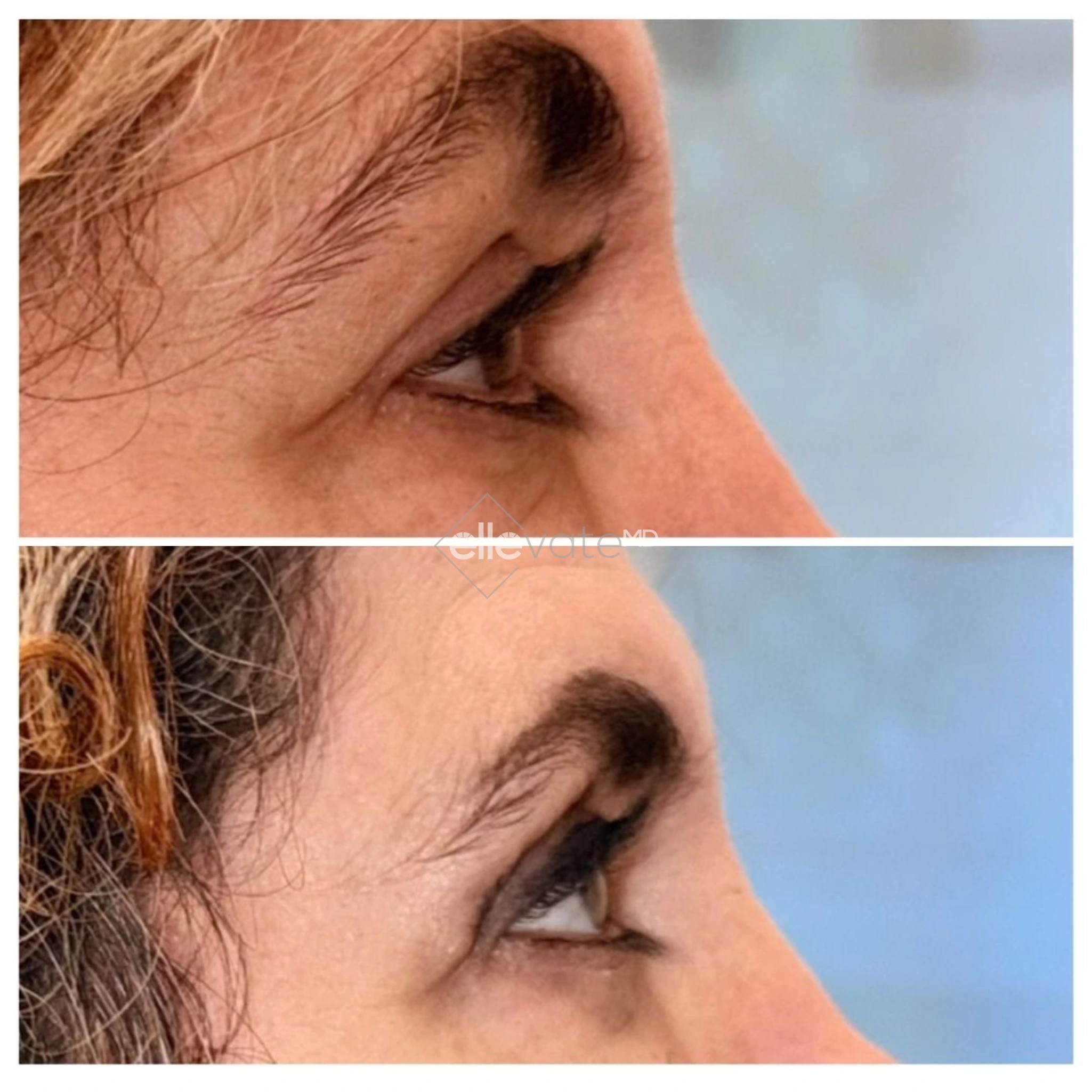 Before and after profile view of patient's mouth and chin area showing Signature Lift results
