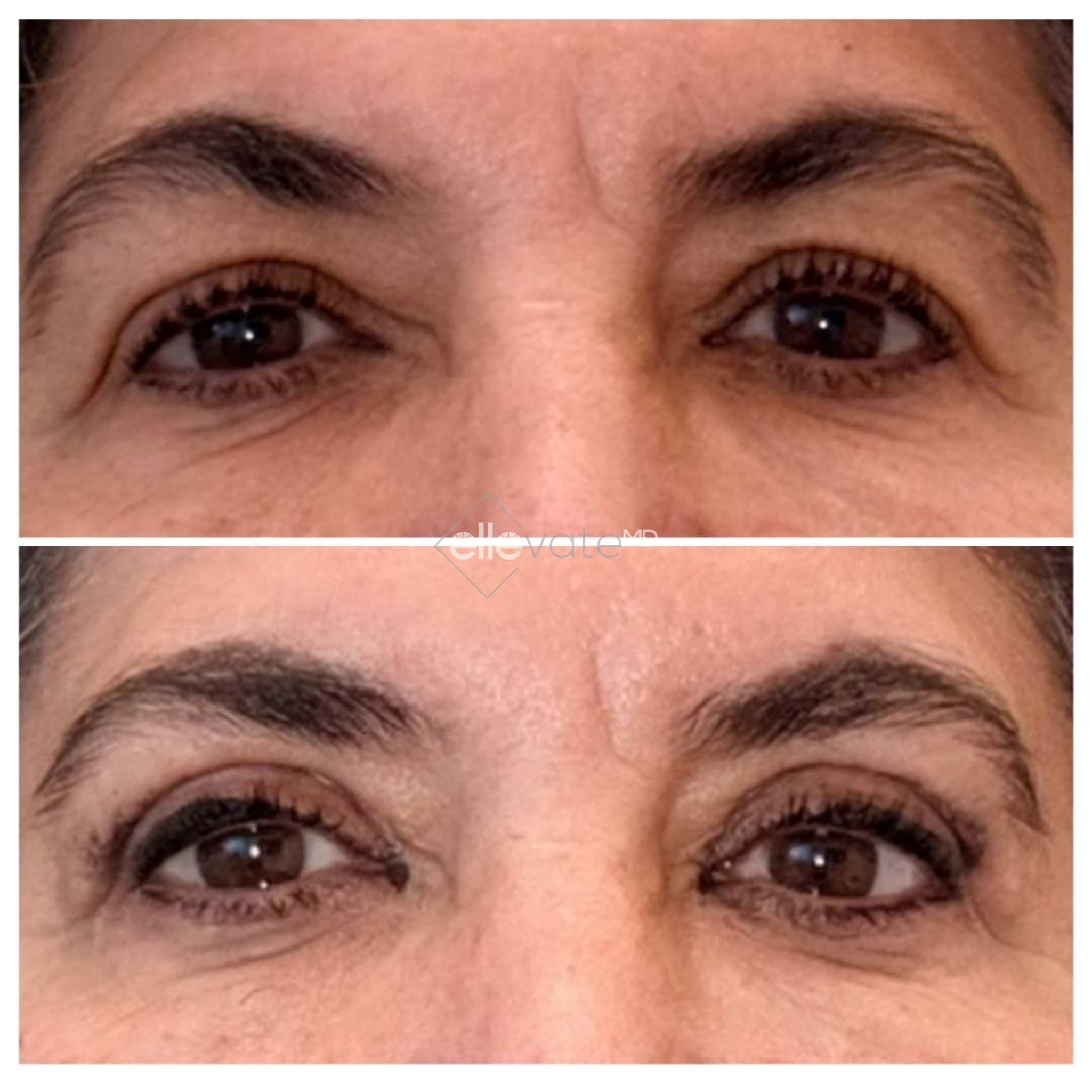 Before and after front view of patient's eyes showing reduced wrinkles from Signature Lift treatment