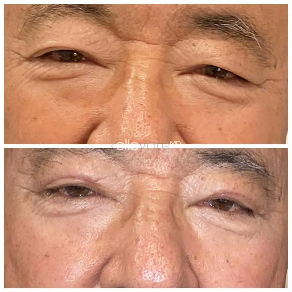 Ptosis-Repair-Before-and-After-Image12