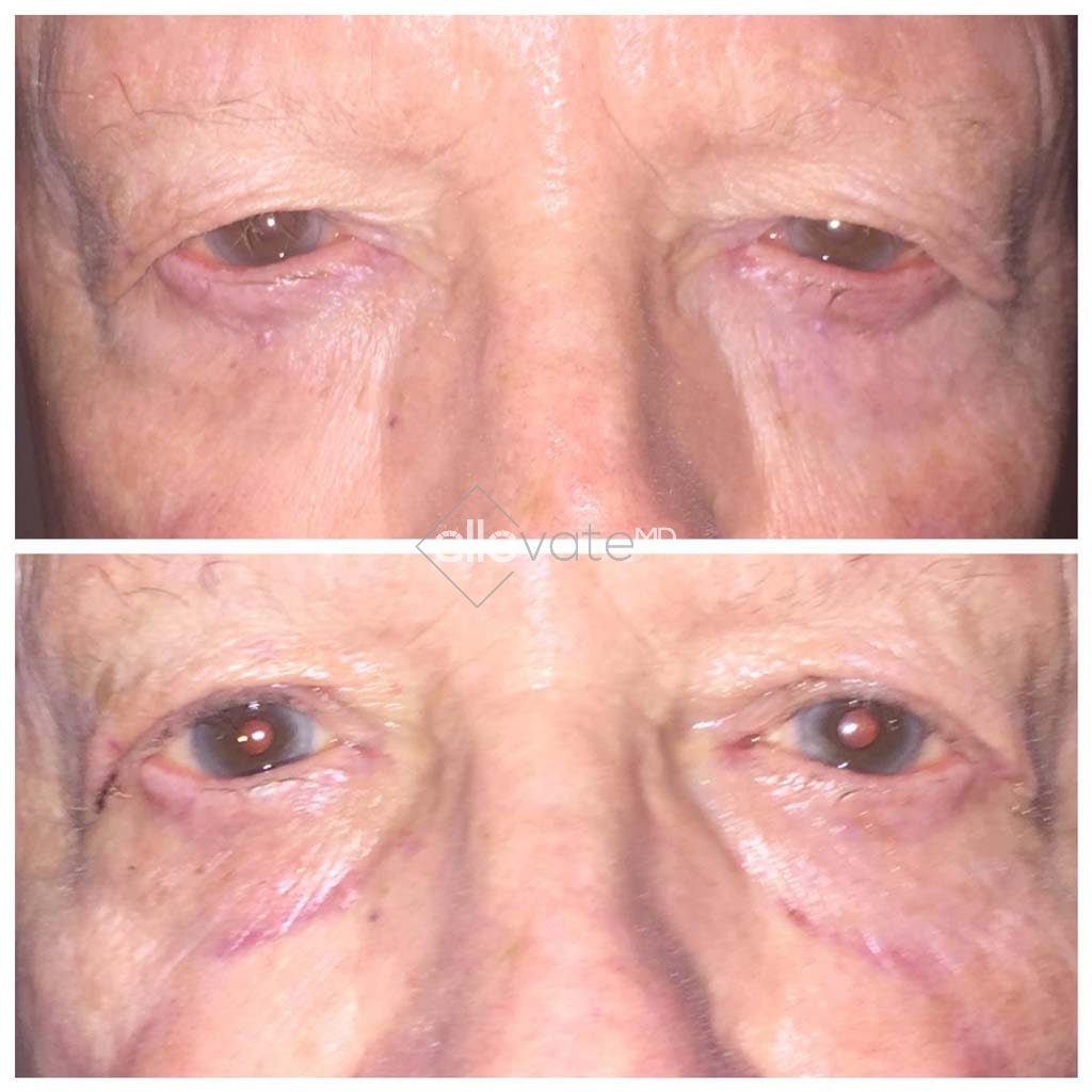 Ptosis-Repair-Before-and-After-Image15