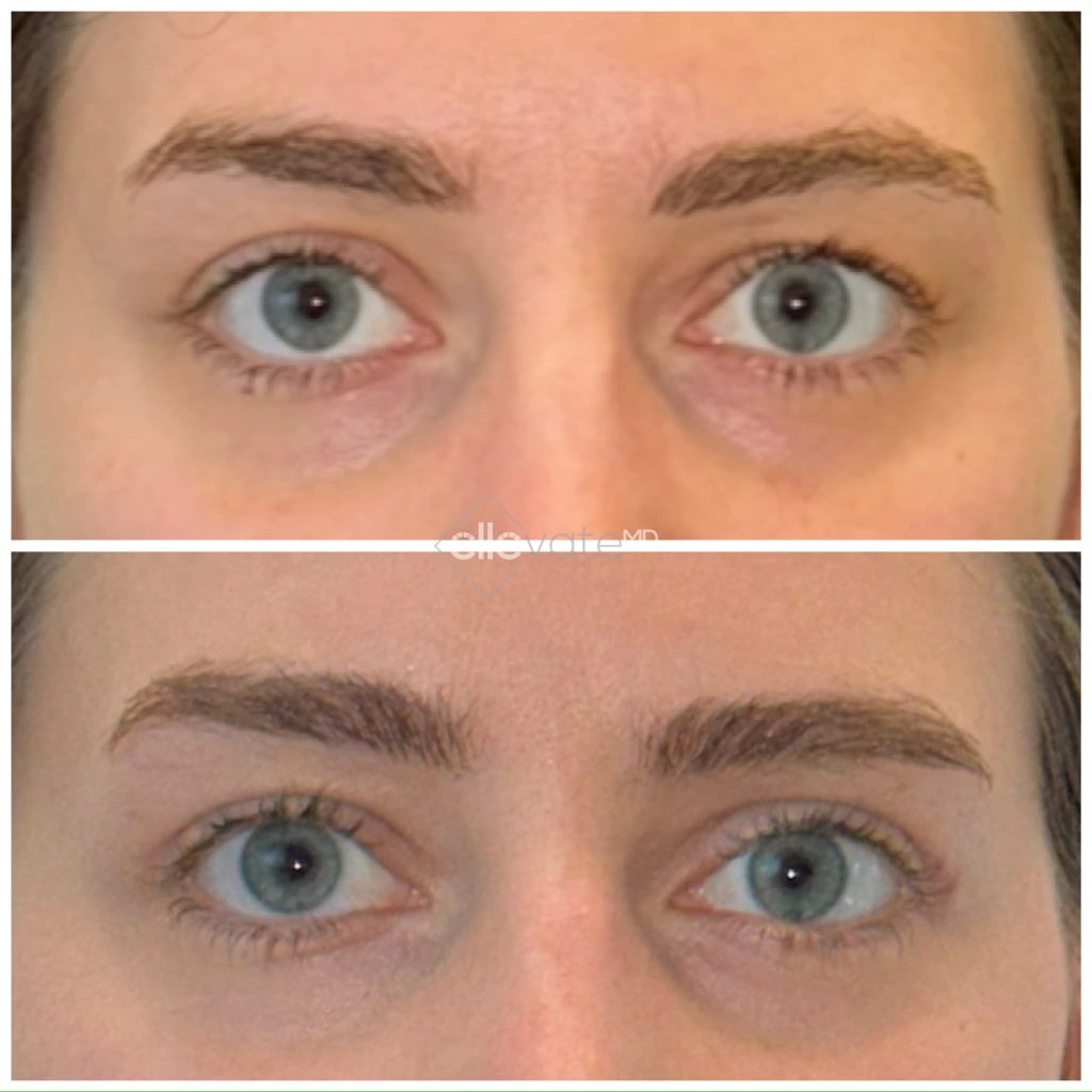 Before and after front view of upper eyelid lift with improved lid opening