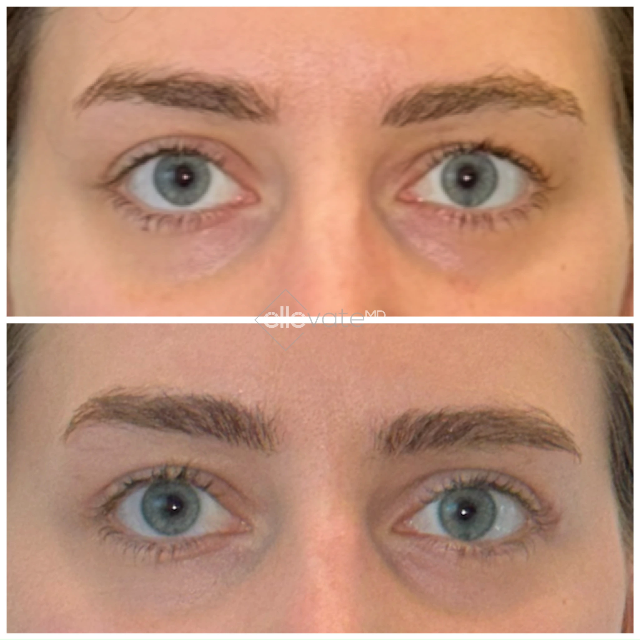 Before and after front view of upper eyelid lift with improved lid opening