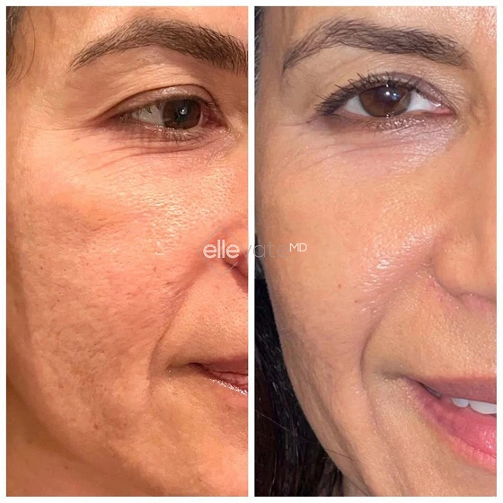 Before and after comparison of eye and cheek area showing reduced wrinkles and improved skin firmness