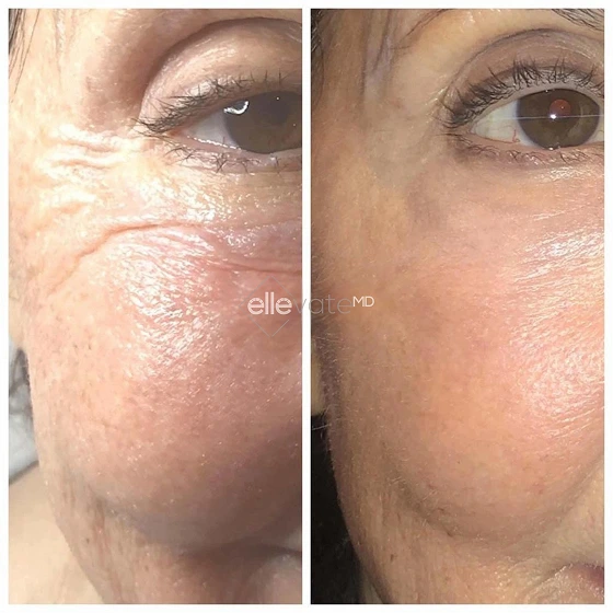 Before and after comparison of eye and cheek area showing reduced crow's feet and improved skin smoothness