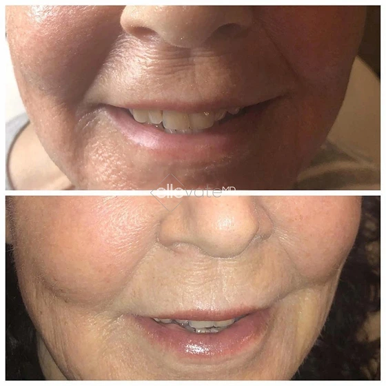 Before and after comparison of lower face showing improved skin texture and reduced fine lines around mouth