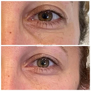 Before and after comparison of eye area showing reduced under-eye wrinkles and improved skin texture