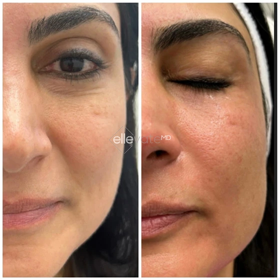 Before and after comparison of face in profile showing improved skin texture and reduced fine lines