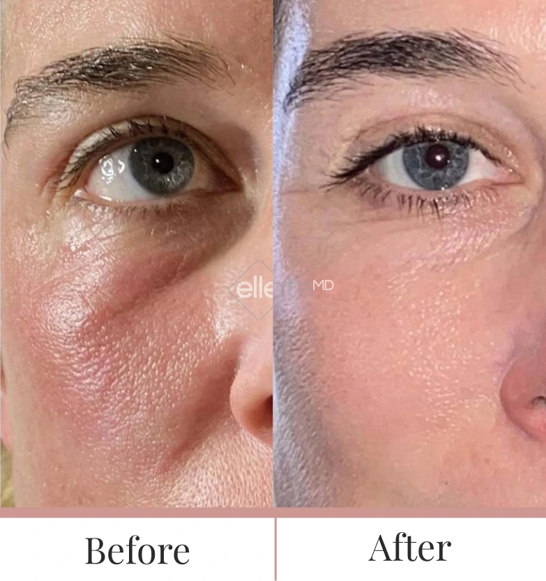Before and after Fraxel laser treatment showing reduced eye wrinkles and improved skin texture