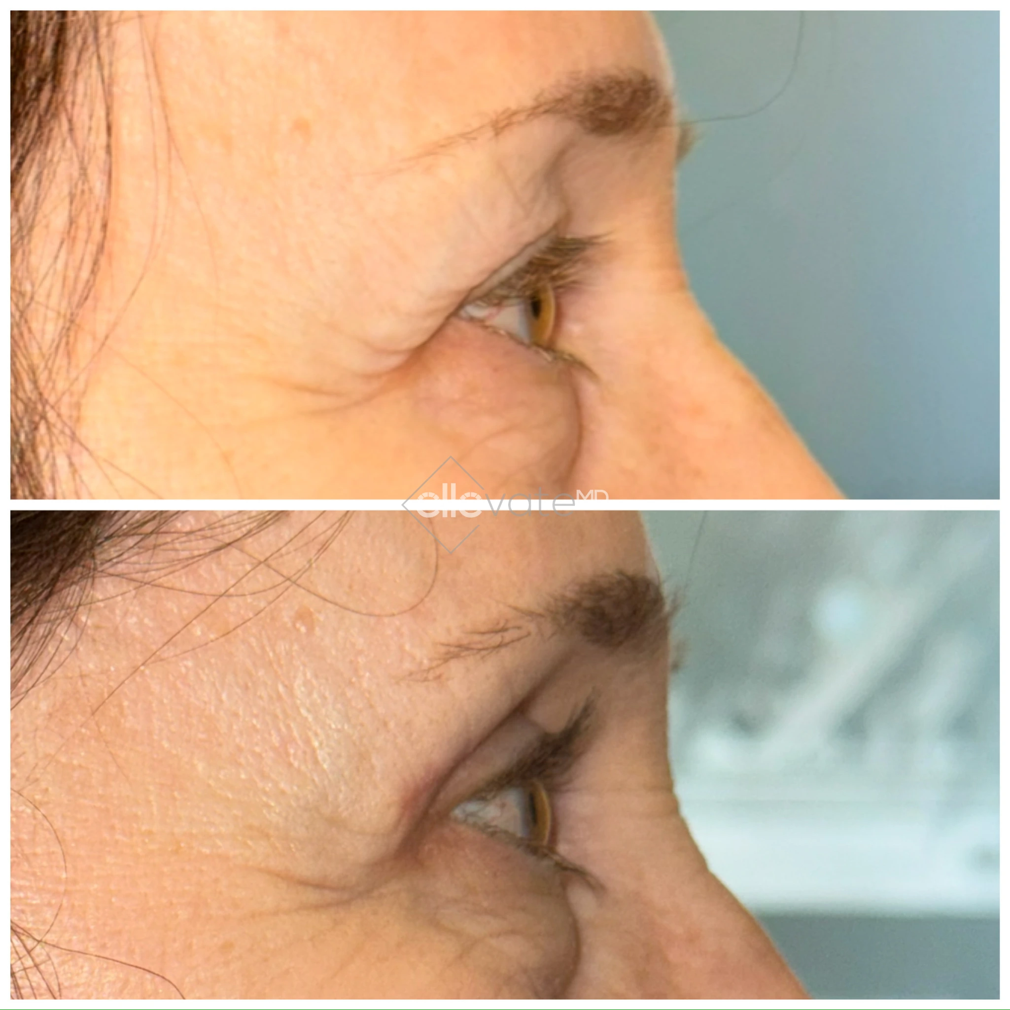 Upper Lid Lift Profile View 73