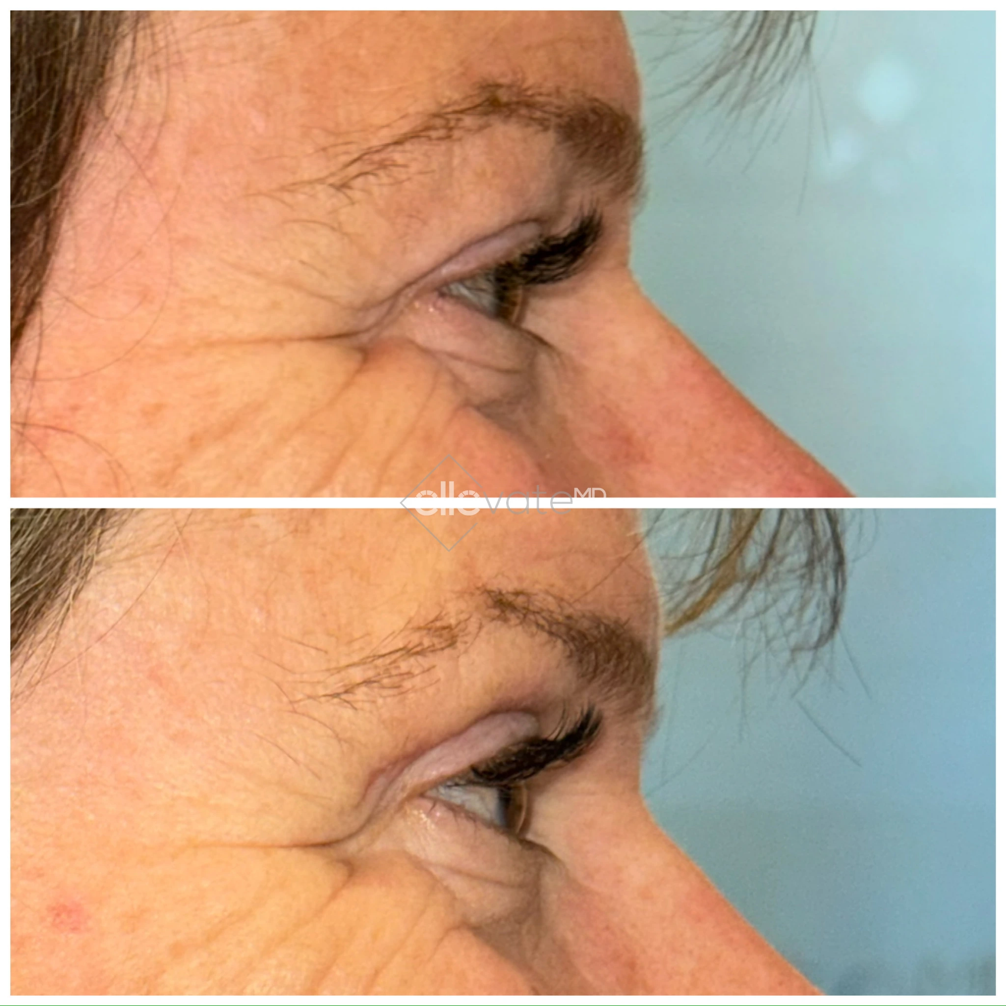 Upper Lid Lift Profile View 75