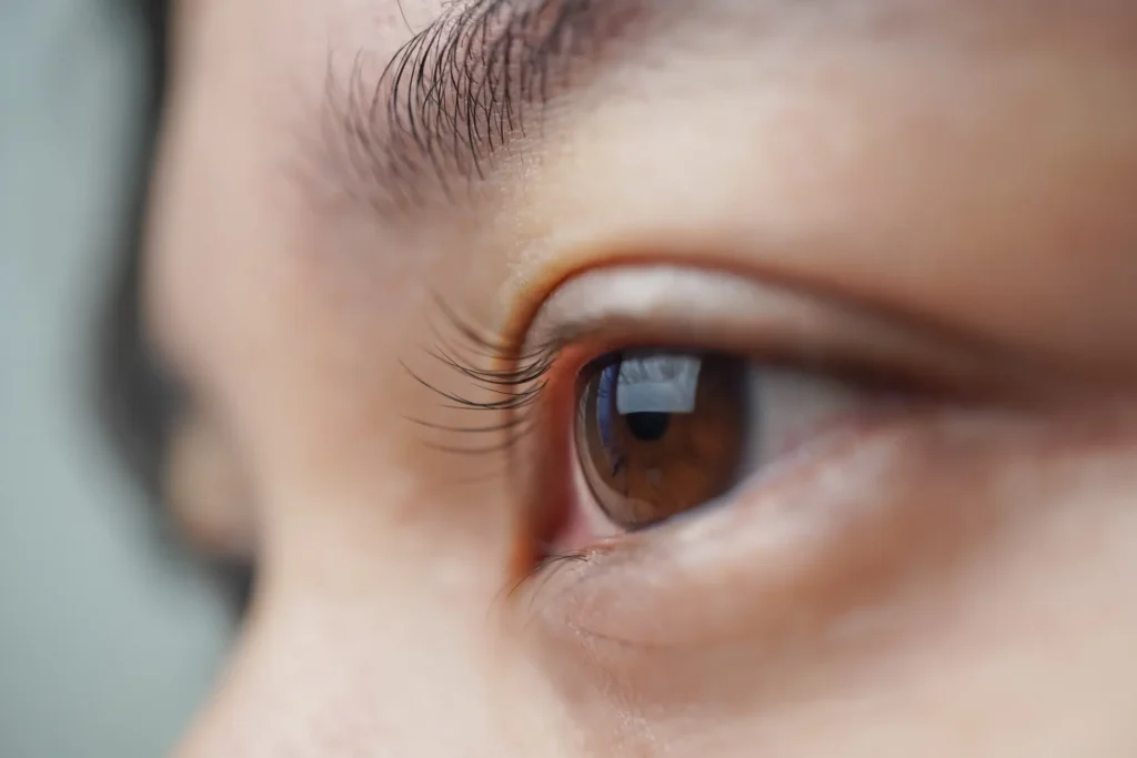 Fraxel Laser and Under-Eye Puffiness Banner
