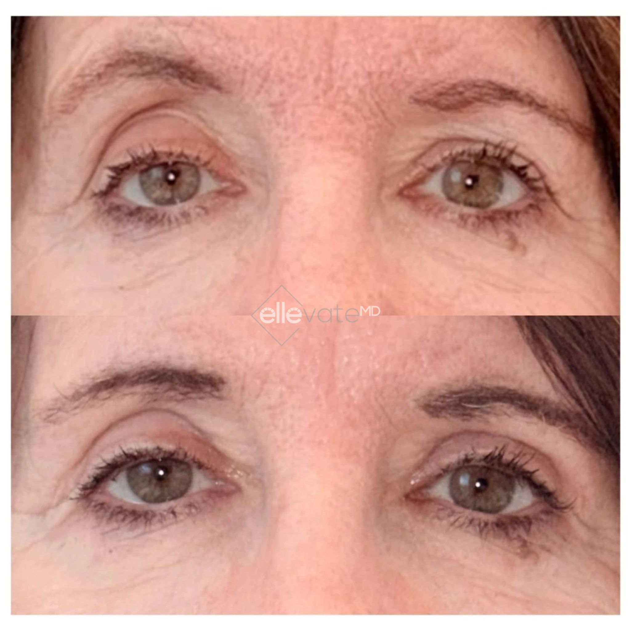 Before and after front view of upper eyelid lift for asymmetry correction