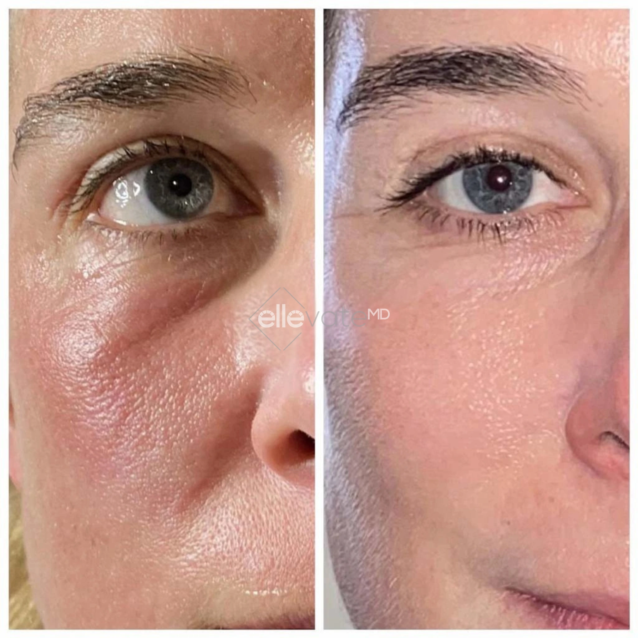 Before and After Gallery: Blepharoplasty Banner