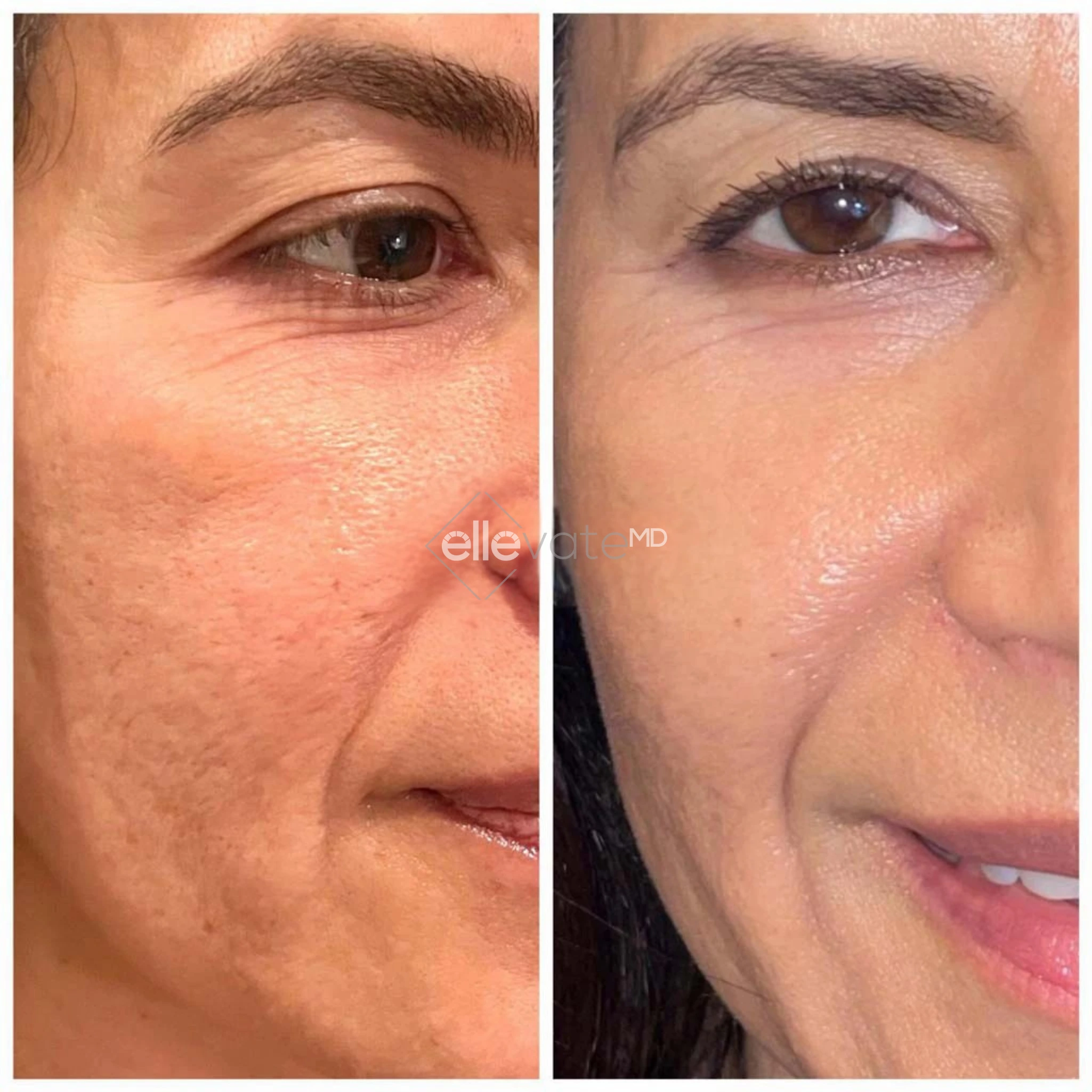 Before and After Gallery: Blepharoplasty Banner