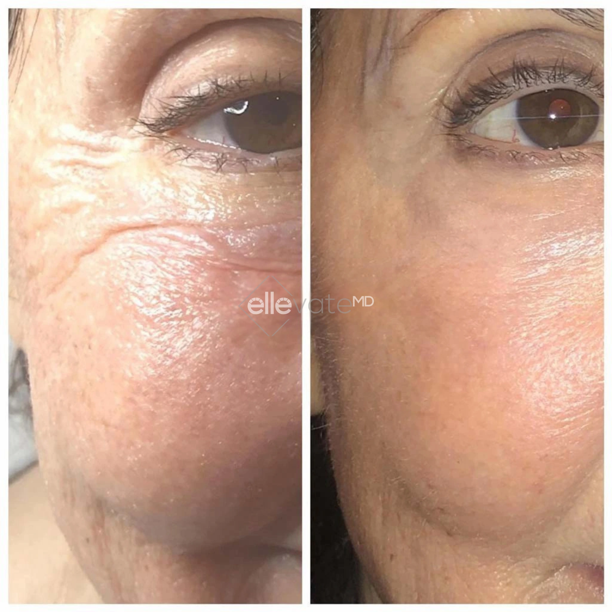 Before and After Gallery: Blepharoplasty Banner
