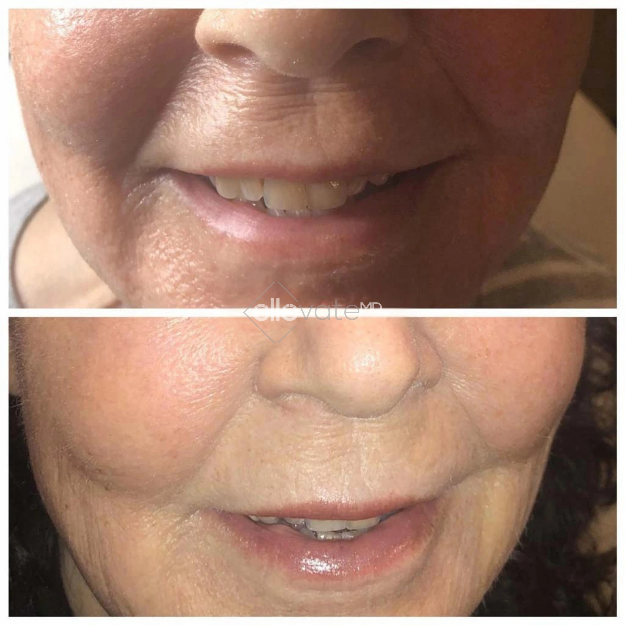 Before and After Gallery: Blepharoplasty Banner