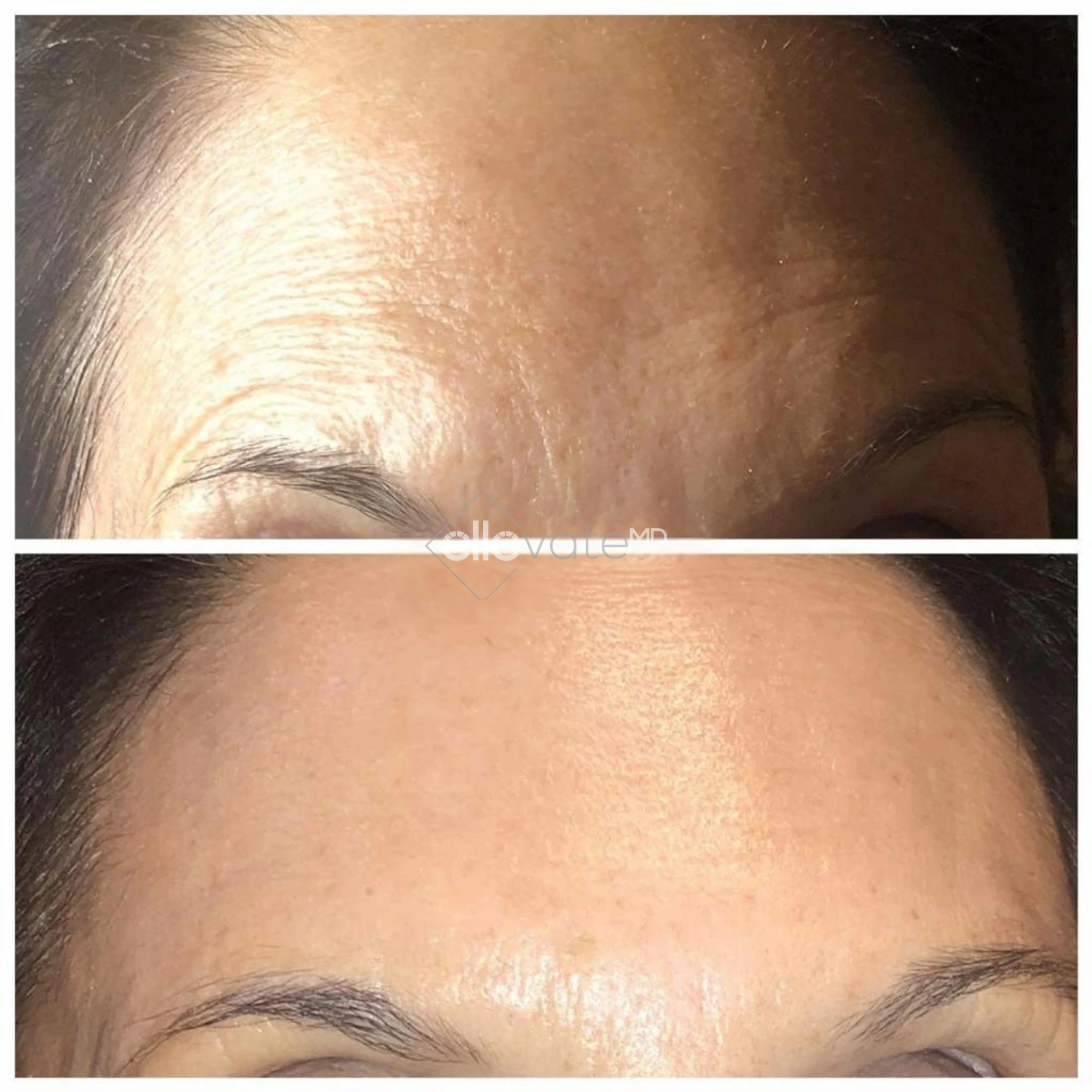Before and After Gallery: Blepharoplasty Banner